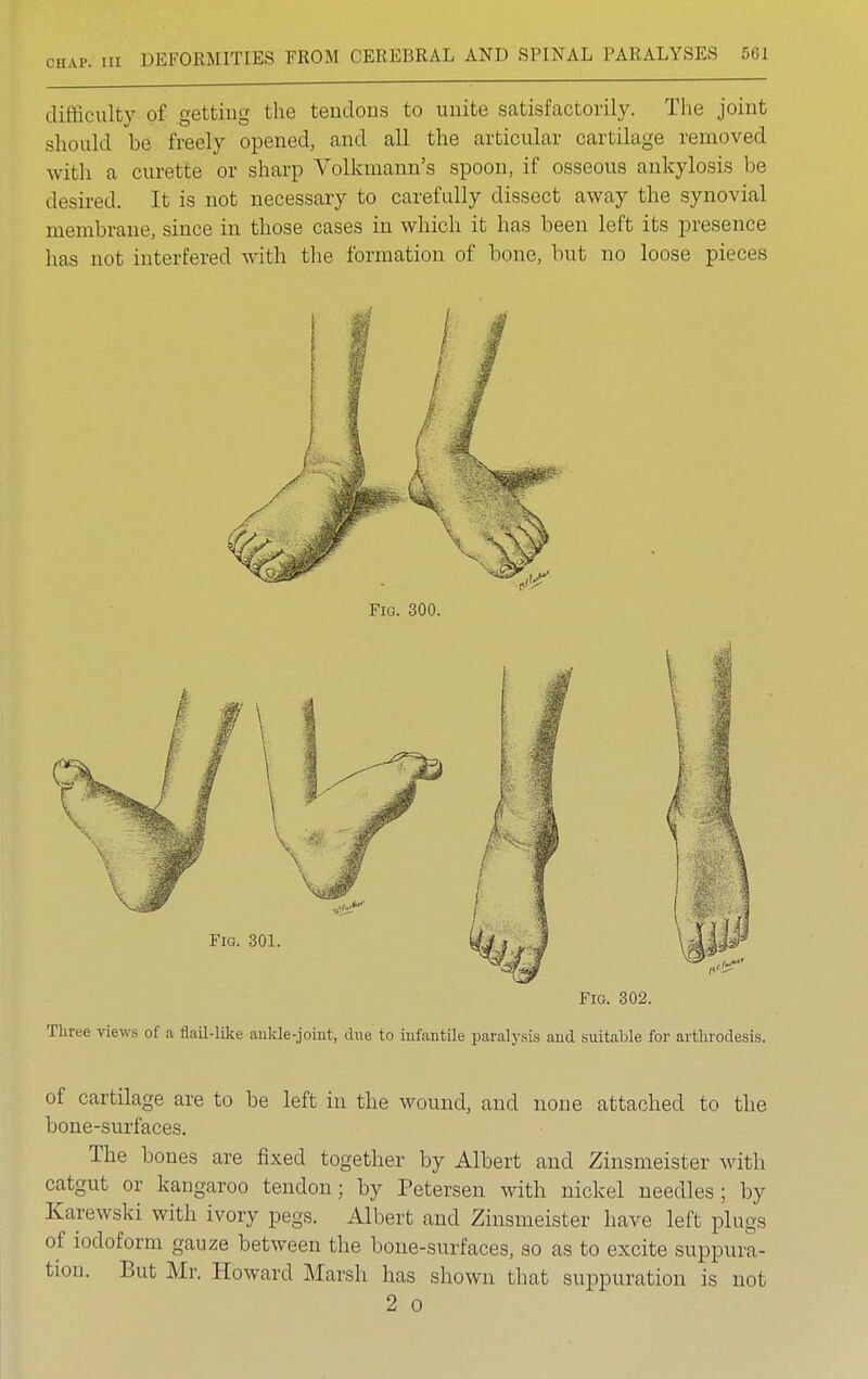 difficulty of getting the tendons to unite satisfactorily. The joint should he freely opened, and all the articular cartilage removed with a curette or sharp Volkmann's spoon, if osseous ankylosis he desired. It is not necessary to carefully dissect away the synovial membrane, since in those cases in which it has been left its presence has not interfered with the formation of hone, hut no loose pieces Fig. 302. Three views of a flail-like ankle-joint, due to infantile paralysis and suitable for arthrodesis. of cartilage are to be left in the wound, and none attached to the bone-surfaces. The bones are fixed together by Albert and Zinsmeister with catgut or kangaroo tendon; by Petersen with nickel needles; by Karewski with ivory pegs. Albert and Zinsmeister have left plugs of iodoform gauze between the bone-surfaces, so as to excite suppura- tion. But Mr. Howard Marsh has shown that suppuration is not 2 o