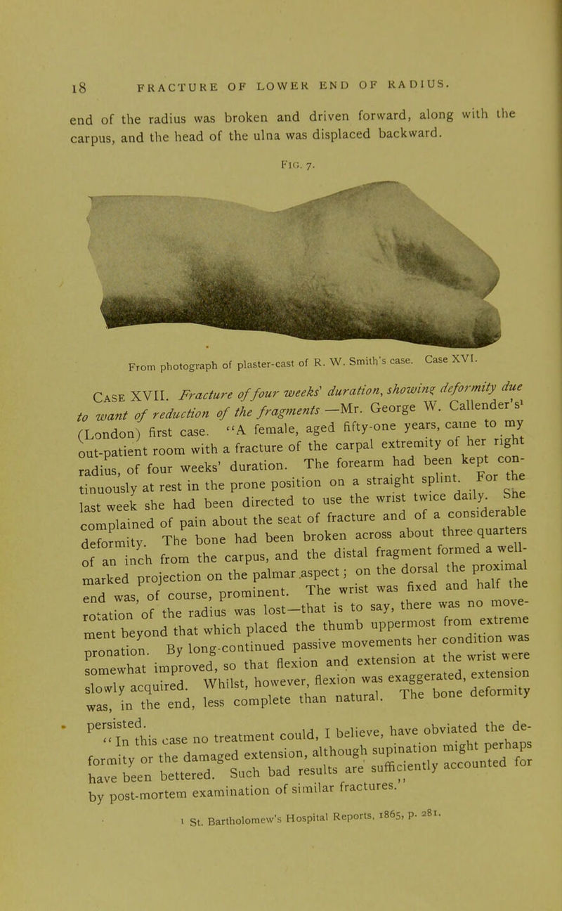 end of the radius was broken and driven forward, along with ilie carpus, and the head of the ulna was displaced backward. Fu;. 7. From photograph of plaster-cast of R. W. Smith's case. Case XVI. Case XVII Fracture of four weeks' duration, showing deformity due to want of reduction of the fragments -Mr. George W. Callender's> (London) first case. -A female, aged fifty-one years, came to my out-patient room with a fracture of the carpal extremity of her right radius of four weeks' duration. The forearm had been kept con- tinuously at rest in the prone position on a straight splmt^ For the 1st week she had been directed to use the wrist twice daily Sne compiled of pain about the seat of fracture and of a considerable deformity. The bone had been broken across about three-quarters o an inch from the carpus, and the distal fragment formed a well- lied projection on the palmar.aspec^^^^^^ ^^^ .^^^ Tnt beyond that which placed the thumb uppermost Trom extren^ Pronation By long-continued passive movements her condition was persisted. ^ obviated the de- ««Tn tViis i-ase no treatment could, i oeiievc, u^v^ ^ by post-mortem examination of similar fractures. 1 St. Bartholomew's Hospital Reports, 1865, P- 281.