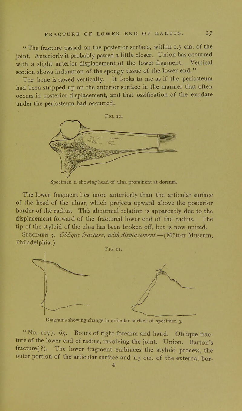 The fracture passed on the posterior surface, within 1.7 cm. of the joint. Anteriorly it probably passed a little closer. Union has occurred with a slight anterior displacement of the lower fragment. Vertical section shows induration of the spongy tissue of the lower end. The bone is sawed vertically. It looks to me as if the periosteum had been stripped up on the anterior surface in the manner that often occurs in posterior displacement, and that ossification of the exudate under the periosteum had occurred. Fig. 10. Specimen 2, showing head of ulna prominent at dorsum. The lower fragment lies more anteriorly than the articular surface of the head of the ulnar, which projects upward above the posterior border of the radius. This abnormal relation is apparently due to the displacement forward of the fractured lower end of the radius. The tip of the styloid of the ulna has been broken off, but is now united. Specimen 3. Oblique fracture, tvith displacevient.—(Mutter Museum, Philadelphia.) Fig. II. Diagrams showing change in articular surface of specimen 3. No. 1277. 65. Bones of right forearm and hand. Oblique frac- ture of the lower end of radius, involving the joint. Union. Barton's fracture(?). The lower fragment embraces the styloid process, the outer portion of the articular surface and 1.5 cm. of the external bor- 4