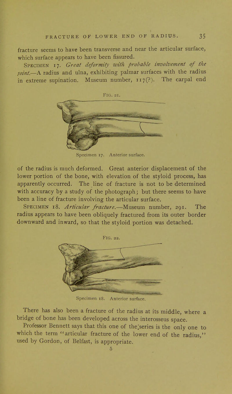 fracture seems to have been transverse and near the articular surface, which surface appears to have been fissured. Specimen 17. Great deformity with probable involvement of the joint.—A radius and ulna, exhibiting palmar surfaces with the radius in extreme supination. Museum number, ii7(?). The carpal end Fig. 21. Specimen 17. Anterior surface. of the radius is much deformed. Great anterior displacement of the lower portion of the bone, with elevation of the styloid process, has apparently occurred. The line of fracture is not to be determined with accuracy by a study of the photograph; but there seems to have been a line of fracture involving the articular surface. Specimen i8. Articular fracture.—Museum number, 291. The radius appears to have been obliquely fractured from its outer border downward and inward, so that the styloid portion was detached. Fig. 22. Specimen i8. Anterior surface. There has also been a fracture of the radius at its middle, where a bridge of bone has been developed across the interosseus space. Professor Bennett says that this one of thejseries is the only one to which the term articular fracture of the lower end of the radius, used by Gordon, of Belfast, is appropriate. 5