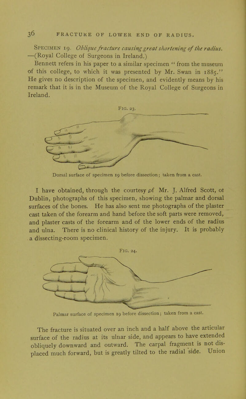 Specimen 19. Oblique fracture causing great shortening of the radius. —(Royal College of Surgeons in Ireland.) Bennett refers in his paper to a similar specimen  from the museum of this college, to which it was presented by Mr. Swan in 1885. He gives no description of the specimen, and evidently means by his remark that it is in the Museum of the Royal College of Surgeons in Ireland. Fig. 23. Dorsal surface of specimen 19 before dissection; taken from a cast. I have obtained, through the courtesy pf Mr. J. Alfred Scott, ot Dublin, photographs of this specimen, showing the palmar and dorsal surfaces of the bones. He has also sent me photographs of the plaster cast taken of the forearm and hand before the soft parts were removed, and plaster casts of the forearm and of the lower ends of the radius and ulna. There is no clinical history of the injury. It is probably a dissecting-room specimen. Fig. 24. Palmar surface of specimen 19 before dissection; taken from a cast. The fracture is situated over an inch and a half above the articular surface of the radius at its ulnar side, and appears to have extended obliquely downward and outward. The carpal fragment is not dis- placed much forward, but is greatly tilted to the radial side. Union