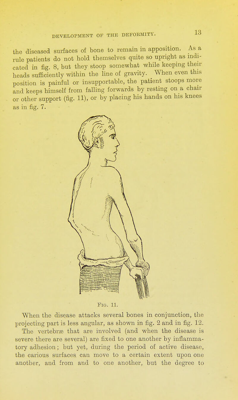 the diseased surfaces of bone to remain in apposition. As a rule patients do not hold themselves quite so upright as indi- cated in fig. 8, but they stoop somewhat while keeping then- heads sufficiently within the line of gravity. When even this position is painful or insupportable, the patient stoops more and keeps himself from falling forwards by resting on a chair or other support (fig. 11), or by placing his hands on his knees as in fig. 7. Fig. 11. When the disease attacks several bones in conjunction, the projecting part is less angular, as shown in fig. 2 and in fig. 12. The vertebrae that are involved (and when the disease is severe there are several) are fixed to one another by inflamma- tory adhesion; but yet, during the period of active disease, the carious surfaces can move to a certain extent upon one another, and from and to one another, but the degree to