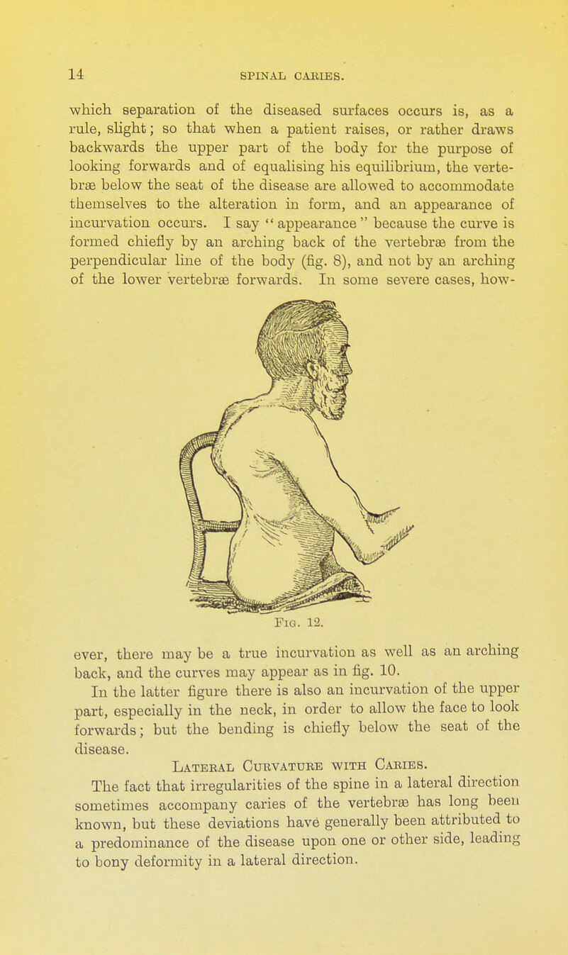 which separation of the diseased surfaces occurs is, as a rule, slight; so that when a patient raises, or rather draws backwards the upper part of the body for the purpose of looking forwards and of equalising his equilibrium, the verte- bras below the seat of the disease are allowed to accommodate tbemselves to the alteration in form, and an appearance of incurvation occurs. I say  appearance  because the curve is formed chiefly by an arching back of the vertebras from the perpendicular line of the body (fig. 8), and not by an arching of the lower vertebras forwards. In some severe cases, how- Fic 12. ever, there may be a true incurvation as well as an arching back, and the curves may appear as in fig. 10. In the latter figure there is also an incurvation of the upper part, especially in the neck, in order to allow the face to look forwards; but the bending is chiefly below the seat of the disease. Lateral Curvature with Caries. The fact that irregularities of the spine in a lateral direction sometimes accompany caries of the vertebrae has long been known, but these deviations have generally been attributed to a predominance of the disease upon one or other side, leading to bony deformity in a lateral direction.