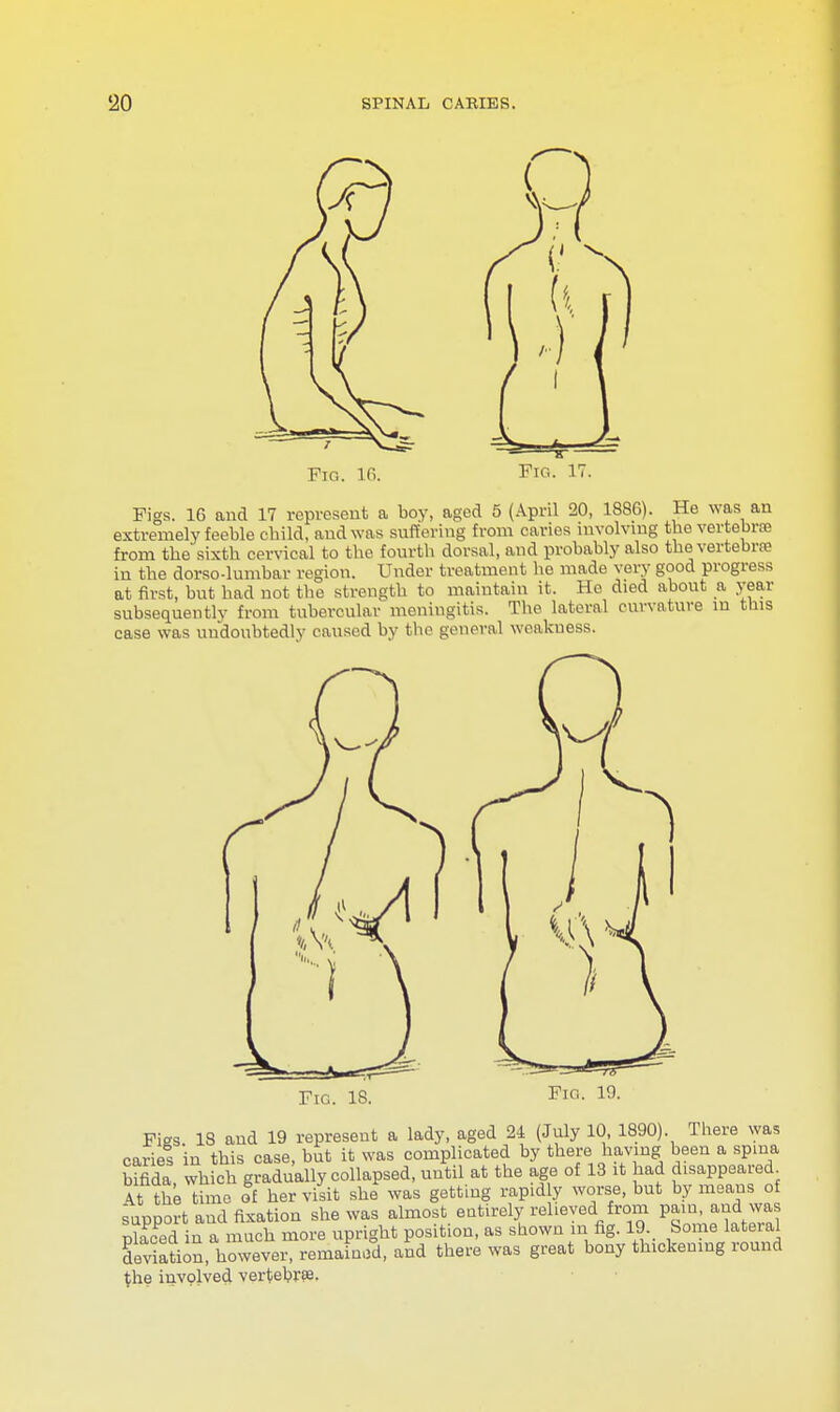 Fig. 16. Fig. 17. Figs. 16 and 17 represent a boy, aged 5 (April 20, 1886). He was an extremely feeble cbild, and was suffering from caries involving the vertebra; from the sixth cervical to the fourth dorsal, and probably also the vertebra; in the dorso-lumbar region. Under treatment he made very good progress at first, but had not the strength to maintain it. He died about a year subsequently from tubercular meningitis. The lateral curvatuve in tins case was undoubtedly caused by the general weakuess. Figs 18 and 19 represent a lady, aged 24 (July 10, 1890). There was caries in this case, but it was complicated by there having been a spma bifida, which gradually collapsed, until at the age of 13 it had disappeared At the time of her visit she was getting rapidly worse, but by means of support and fixation she was almost entirely relieved from pain, and was Zed in a much more upright position, as shown m fig. 19 borne lateral deviation, however, remained, and there was great bony thickening round the involved vertebra;.