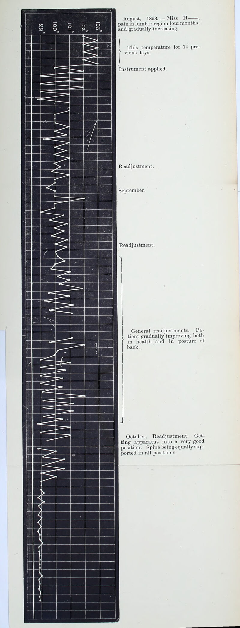 August, 1893. — Miss H , pain in lumbar region fourmonths, and gradually increasing. ' This temperature for 14 pre- I vious days. Instrument applied. Readjustment. September. Readjustment. n General readjustments. Pa- ! tient gradually improving both in health and in posture of back. October. Eeadjustment. Get- ting apparatus into a very good position. Spine being equally sup- ported in all positions.