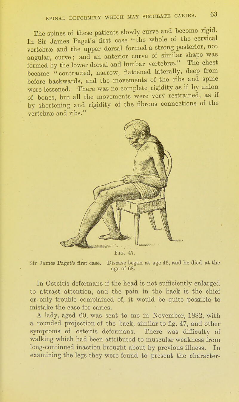 The spines of these patients slowly curve and hecome rigid. In Sir James Paget's first case the whole of the cervical vertebra and the upper dorsal formed a strong posterior, not angular, curve; and an anterior curve of similar shape was formed by the lower dorsal and lumbar vertebras. The chest became contracted, narrow, flattened laterally, deep from before backwards, and the movements of the ribs and spine were lessened. There was no complete rigidity as if by union of bones, but all the movements were very restrained, as if by shortening and rigidity of the fibrous connections of the vertebrae and ribs. Fig. 47. Sir James Paget's first case. Disease began at age 46, and he died at the age of 68. In Osteitis deformans if the head is not sufficiently enlarged to attract attention, and the pain in the back is the chief or only trouble complained of, it would be quite possible to mistake the case for caries. A lady, aged 60, was sent to me in November, 1882, with a rounded projection of the back, similar to fig. 47, and other symptoms of osteitis deformans. There was difficulty of walking which had been attributed to muscular weakness from long-continued inaction brought about by previous illness. In examining the legs they were found to present the character-