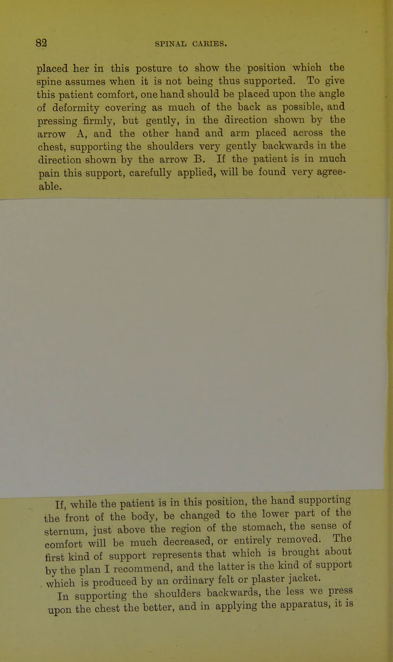 placed her in this posture to show the position which the spine assumes when it is not being thus supported. To give this patient comfort, one hand should be placed upon the angle of deformity covering as much of the back as possible, and pressing firmly, but gently, in the direction shown by the arrow A, and. the other hand and arm placed across the chest, supporting the shoulders very gently backwards in the direction shown by the arrow B. If the patient is in much pain this support, carefully applied, will be found very agree- able. If, while the patient is in this position, the hand supporting the front of the body, be changed to the lower part of the sternum, just above the region of the stomach, the sense of comfort will be much decreased, or entirely removed. The first kind of support represents that which is brought about by the plan I recommend, and the latter is the kind of support which is produced by an ordinary felt or plaster jacket. In supporting the shoulders backwards, the less we press upon the chest the better, and in applying the apparatus, it is