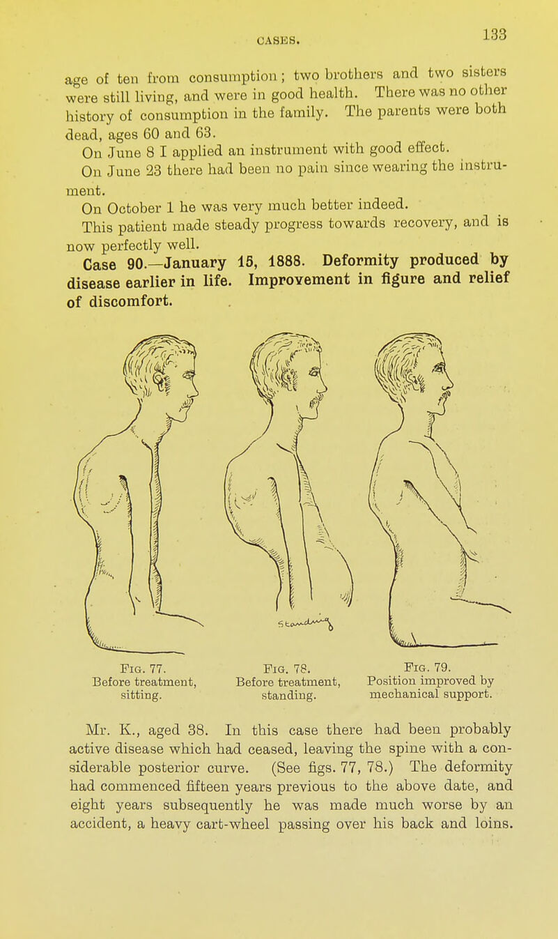 age of ten from consumption; two brothers and two sisters w°ere still living, and were in good health. There was no other history of consumption in the family. The parents were both dead, ages 60 and 63. On June 8 I applied an instrument with good effect. On June 23 there had been no pain since wearing the instru- ment. On October 1 he was very much better indeed. This patient made steady progress towards recovery, and is now perfectly well. Case 90.—January 15, 1888. Deformity produced by disease earlier in life. Improvement in figure and relief of discomfort. Pig. 77. Pig. 78. Pig. 79. Before treatment, Before treatment, Position improved by sitting. standing. mechanical support. Mr. K., aged 38. In this case there had been probably active disease which had ceased, leaving the spine with a con- siderable posterior curve. (See figs. 77, 78.) The deformity had commenced fifteen years previous to the above date, and eight years subsequently he was made much worse by an accident, a heavy cart-wheel passing over his back and loins.