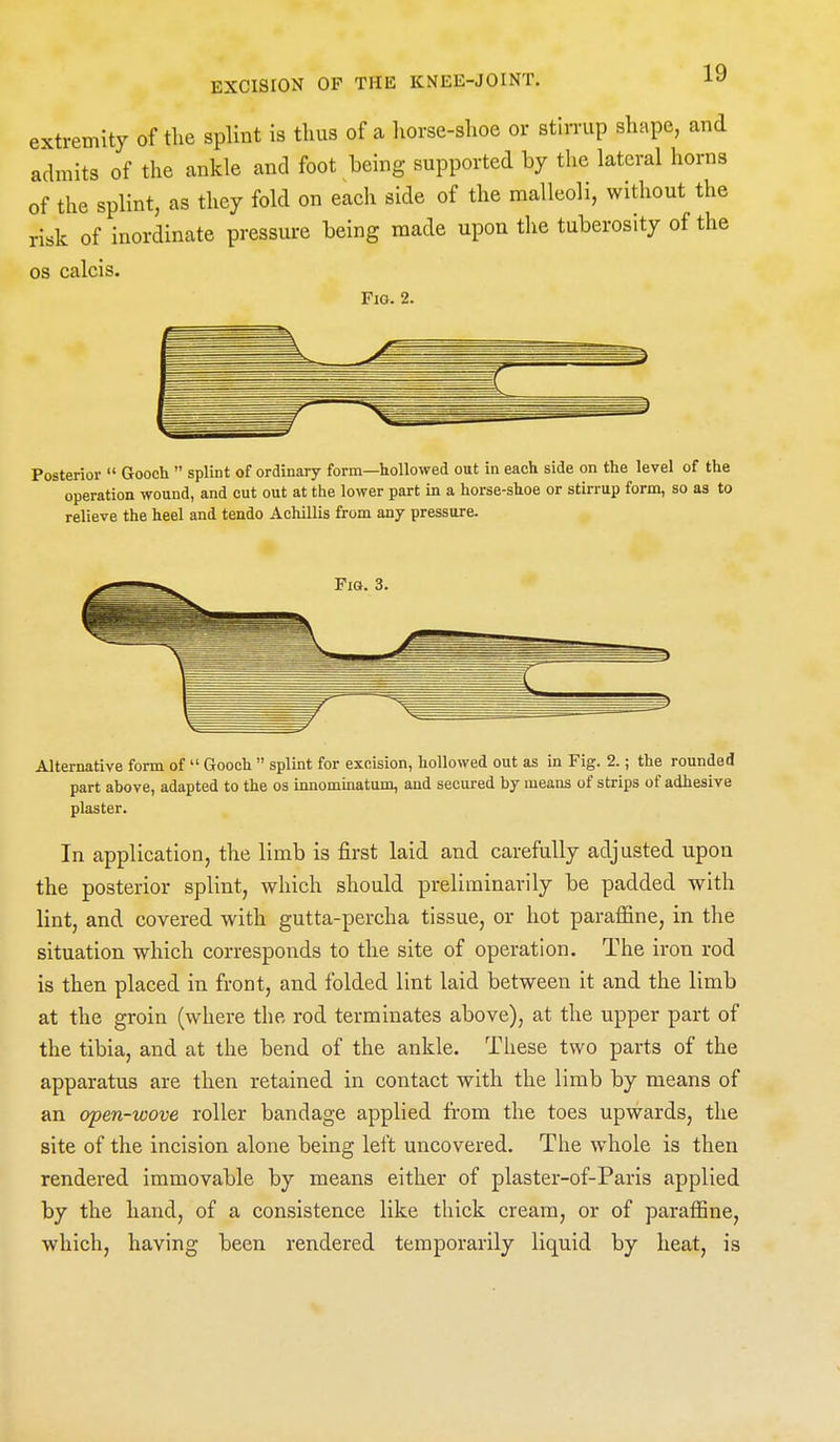 extremity of the splint is thus of a liorse-slioe or stirrup shape, and admits of the ankle and foot being supported by the lateral horns of the splint, as they fold on each side of the malleoli, without the risk of inordinate pressure being made upon the tuberosity of the OS calcis. Fio. 2. Posterior  Gooch  splint of ordinary form—hollowed out in each side on the level of the operation wound, and cut out at the lower part in a horse-shoe or stirrup form, so as to relieve the heel and tendo Achillis from any pressure. Alternative form of  Gooch  splint for excision, hollowed out as in Fig. 2.; the rounded part ahove, adapted to the os innominatum, and secured by means of strips of adhesive plaster. In application, the limb is first laid and carefully adjusted upon the posterior splint, which should preliminarily be padded with lint, and covered with gutta-percha tissue, or hot paraffine, in the situation which corresponds to the site of operation. The iron rod is then placed in front, and folded lint laid between it and the limb at the groin (where the rod terminates above), at the upper part of the tibia, and at the bend of the ankle. Tiiese two parts of the apparatus are then retained in contact with the limb by means of an open-wove roller bandage applied from the toes upwards, the site of the incision alone being left uncovered. The whole is then rendered immovable by means either of plaster-of-Paris applied by the hand, of a consistence like thick cream, or of paraffine, which, having been rendered temporarily liquid by heat, is