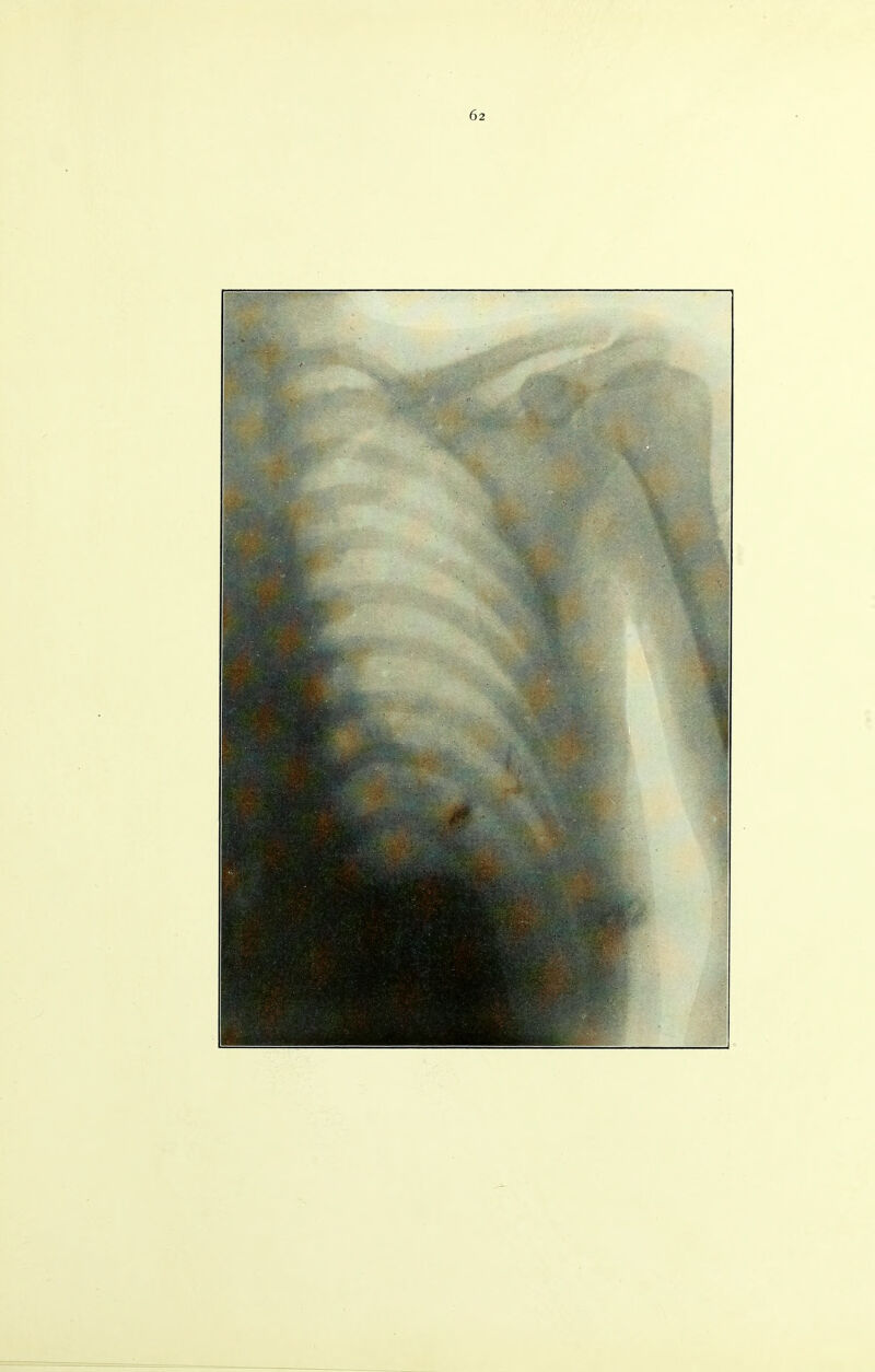 62 r