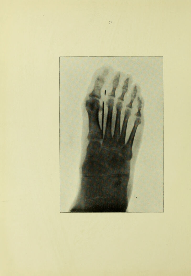 72