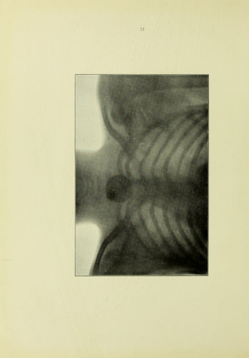 75