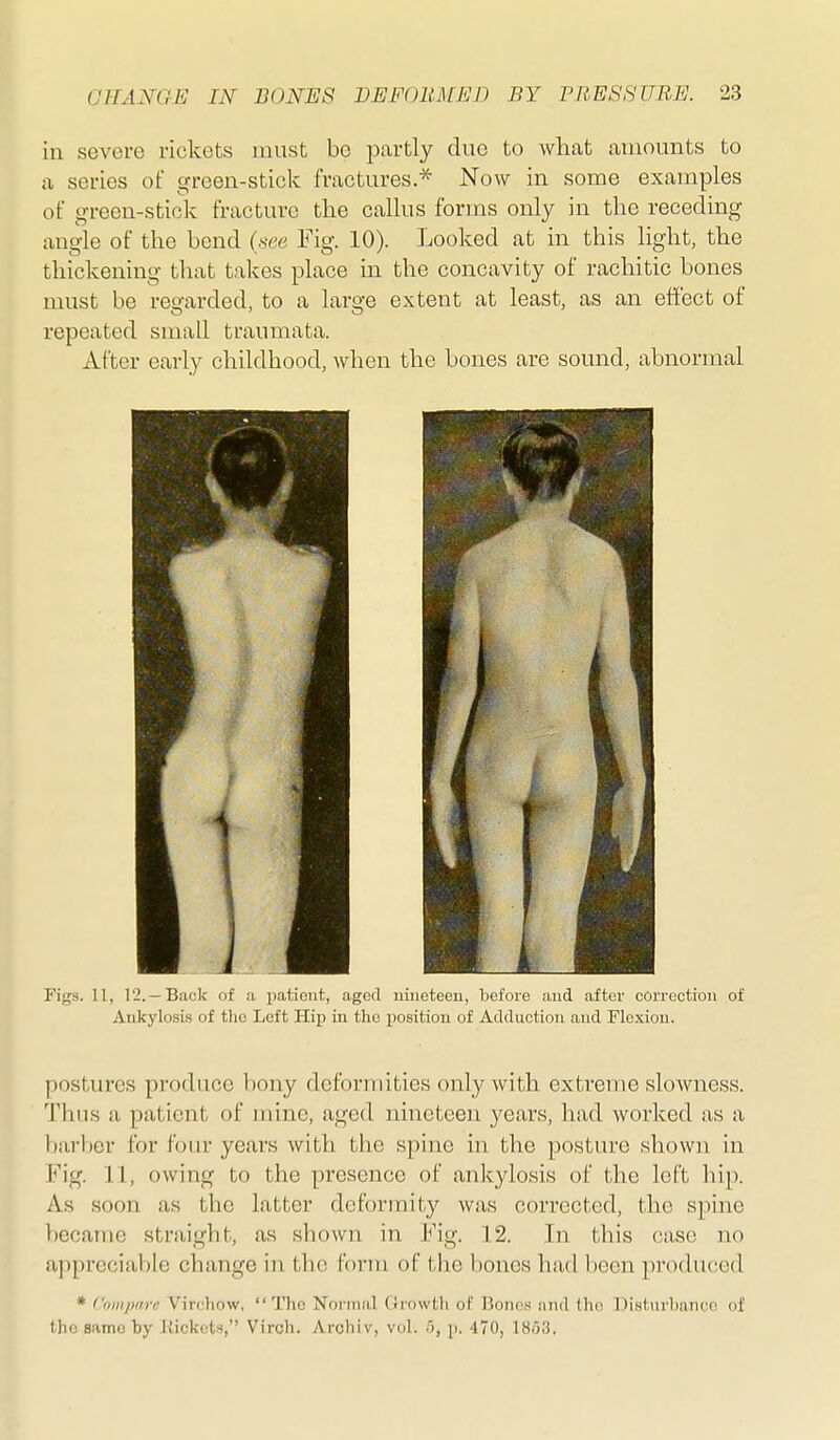 in severe rickets must be partly due to what amounts to a series of green-stick fractures.* Now in some examples of green-stick fracture the callus forms only in the receding angle of the bend {see Fig. 10). Looked at in this light, the thickening that takes place in the concavity of rachitic bones must be regarded, to a large extent at least, as an effect of repeated small traumata. After early childhood, when the bones are sound, abnormal Figs. 11, 12. —Back of a iiatieut, aged uiiieteeu, before aud after correction of Ankylosis of the Left Hip in the position of Adduction and Flexion. postures produce bony deformities only with extreme slowness. Thus a patient of mine, aged nineteen 3'ears, had worked as a barber for four years with the spine in the posture shown in Fig. 11, owing to the presence of ankylosis of the left hip. As soon as the latter deformity was corrected, the spme became straight, as shown in Fig. 12. In this case no appreciable change in the form of the bones had been produced * Ciinipdre Virchow, The Normal Oiowth of Bon(!M iind (ho Disturbance of llio same by ilickets, Virch. Archiv, vol. '), p. 470, 18ij3.