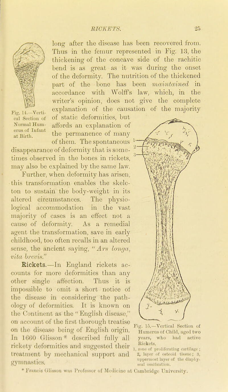 If Fig. 14.-Verti- cal Sectiou of Normal Hum- erus of lufaut at Bii'th. long- after the disease has been recovered from. Thus in the femur represented in Fig. 13, the thickenino- of the concave side of the rachitic bend is as great as it was during the onset of the deformity. The nutrition of the thickened part of the bone has been maintained in accordance with Wolffs law. which, in the Avriter's opinion, does not give the complete explanation of the causation of the majority of static deformities, but affords an explanation of the permanence of many of them. The spontaneous disappearance of deformity that is some- times observed in the bones in rickets, may also be explained by the same law. Further, when deformity has arisen, tbis transformation enables the skele- ton to sustain the body-weight in its altered circumstances. The physio- losfical accommodation in the vast majority of cases is an effect not a cause of deformity. As a remedial agent the transformation, save in early childhood, too often recalls in an altered sense, the ancient saying,  Ars longa, vita, hreim. Rickets.—In England rickets ac- counts for more deformities than any other single affection. Thus it is impossible to omit a short notice of the disease in considering the path- ology of deformities. It is known on the Continent as the  Enfjiish disease, on account of the first thorough treatise on the disease being of English origin. In 16G0 Glisson* described fully all rickety deformities and suggested their treatment by mechanical support and gymnastics. M 7. ■3. Fig. 15.—Vcrticiil Sectiou of Humerus of Child, aged two yeans, who had active Rickets. 1, zniic of iinilifcnitiiig cartilage ; 2, lii.v('i' 111' stcoiil tissue; !1, iipiicniKist layer of the ilinjiliy- seal (issilical-iiiii. i'Vuiicis Oliusoii was Professor of Medicine at Cambridge University,