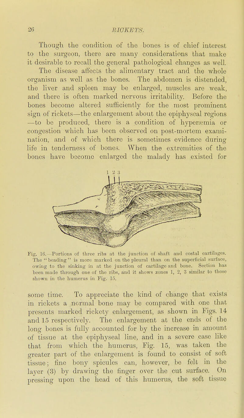 Thougli the condition of the bones is of chief interest to the surgeon, there are many considerations that make it desirable to recall the general pathological changes as well. The disease affects the alimentary tract and the whole organism as well as the bones. The abdomen is distended, the liver and spleen may be enlarged, muscles are weak, and there is often marked nervous irritability. Before the bones become altered sufficiently for the most prominent sign of rickets—the enlargement about the epiphyseal regions —to be produced, there is a condition of hypenemia or congestion which has been observed on post-mortem exami- nation, and of which there is sometimes evidence durinsr life in tenderness of bones. When the extremities of the bones have become enlarged the malady has existed for 12 3 Fig. IG.—Portions of three ribs at the juuctioii of shaft and costal cartilages. The beading is more marked on the pleural tlian on tlie superficial surface, owing to the sinking in at the junction of cartilage and bone. Section has been made through one of the ribs, and it shows zones 1, 2, 3 similar to tliose shown in the humerus in Fig. 15. some time. To appreciate the kind of change that exists in rickets a normal bone may be compared with one that presents marked rickety enlargement, as shown in Figs. 14 and 15 respectively. The enlargement at the ends of the long bones is fully accounted for by the increase in amount of tissue at the epiphyseal line, and in a severe case like that from which the humerus. Fig. 15, was taken the greater part of the enlargement is found to consist of soft tissue; fine bony spicules can, however, be felt in the layer (3) by drawing the finger over the cut surface. On pressing upon the head of this humerus, the soft tissue