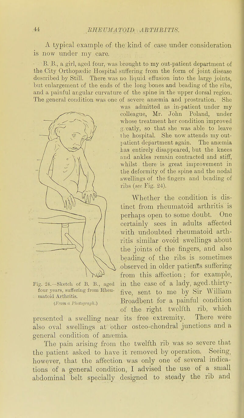 A typical example of the kind of case under consideration is now under my care. B. B., a girl, aged four, was brought to my out-patient department of the City Orthopaedic Hospital suffering from the form of joint disease described by Still. There was no li(|uid effusion into the large joints, but enlargement of the ends of the long bones and beading of the ribs, and a painful angular curvature of the spine in the upper dorsal region. The general condition was one of severe antemia and prostration. She was admitted as in-patient under my colleague, Mr. John Poland, under whose treatment her condition improved g . catly, so that she was able to leave \ he hospital. She now attends my out- patient department again. The anaemia Las entirely disappeai'ed, but the knees and ankles rema,in contracted and stiff, whilst ^ there is great improvement in the deformity of the spine and the nodal swellings of the lingers and beading of ribs (see Fig. 24). Whether the condition is dis- tinct from rlieumatoid arthritis is perhaps open to some doubt. One certainly sees in adults afiected with undoubted rheumatoid arth- ritis similar ovoid swellings about the joints of the fingers, and also beadina: of the ribs is sometimes observed in older patients suffering from this affection; for example. Fig. 24.-Sketch of B. B., aged in the CaSC of a lady, aged.thirty- four years, suifermg from Eheu- ggj^(. j^w Sir William matoid Ai-thritis. „ ' -,, ^ • /• i t^- iFromaPkoto,rapk.) Broadbcnt for a pamtul condition of the right twelfth rib, which presented a swelling near its free extremity. There Averc also oval swellings at other osteo-chondral junctions and a general condition of anaimia. The pain arising from the twelfth rib was so severe that the patient asked to have it removed by operation. Seeing, however, that the affection was only one of several indica- tions of a general condition, I advised the use of a small abdominal belt specially designed to steady the rib and