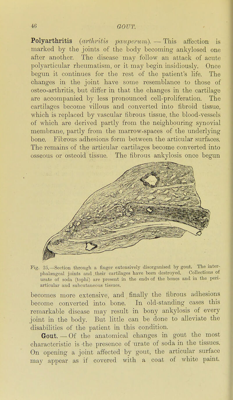 Polyarthritis (arthritis pauppyrum). — This affection is marked by the joints of the body becoming ankylosed one after another. The disease may follow an attack of acute polyarticular rheumatism, or it may begin insidiously. Once begun it continues for the rest of the patient's life. The changes in the joint have some resemblance to those of osteo-arthritis, but differ in that the changes in the cartilage are accompanied by less pronounced cell-proliferation. The cartilages become villous and converted into fibroid tissue, which is replaced by vascular fibrous tissue, the blood-vessels of which are derived partly from the neighbouring synovial membrane, partly from the marrow-spaces of the underlying bone. Fibrous adhesions form between the articular surfaces. The remains of the articular cartilasres become converted into osseous or osteoid tissue. The fibrous ankylosis once begun Fig. 25.—Section through a finger extensively disorgcanisecl by gout. The inter- phalangeal joints and .their cartilages have been destroyed. Collections of urate of soda (tophi) are present in the ends of the bones and in the peri- articular and subcutaneous tissues. becomes more extensive, and finally the fibrous adhesions become converted into bone. In old-standing cases this remarkable disease may result in bony ankylosis of every joint in the body. But little can be done to alleviate the disabilities of the patient in this condition. Gout. — Of the anatomical changes in gout the most characteristic is -the presence of urate of soda in the tissues. On opening a joint affected by gout, the articular surface may appear as if covered with a coat of white paint.