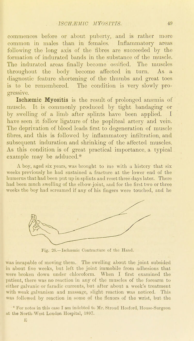 commences before or about puberty, and is rather more common in males than in females. Inflammatory areas following the long axis of the fibres are succeeded by the formation of indurated bands in the substance of the muscle. The indurated areas finally become ossified. The muscles throughout the body become affected in turn. As a diagnostic feature shortening of the thumbs and great toes is to be remembered. The condition is very slowly pro- gressive. Ischsemic Myositis is the result of prolonged anaemia of muscle. It is commonly produced by tight bandaging or by swelling of a limb after splints have been applied. I have seen it follow ligature of the popliteal artery and vein. The deprivation of blood leads first to degeneration of muscle fibres, and this is followed by inflammatory infiltration, and subsequent induration and shrinking of the affected muscles. As this condition is of great practical importance, a typical example may be adduced.* A boy, aged six years, was brought to rae with a history that six weeks previously he had sustained a fracture at the lower end of the humerus that had been put up in splints and reset three days later. There had been much swelling of the elbow-joint, and for the first two or three weeks the boy had screamed if any of his fingers were touched, and he Fig. 26.—Ischasmic Contraotiiro of the Hand. was incai)able of moving them. The swelling about the joint subsided in about five weeks, but left the joint immobile from adliesions that were broken down under chloroform. When I first examined the ])atient, there was no reaction in any of the muscles of the forearm to either galvanic or faradic currents, but after about a week's treatment with weak galvanism and massage, slight reaction was noticed. This was followed by reaction in some of the flexors of the wrist, but the * For notes in this case \. am iinlohtojd to Mr. Stroud Hosford, Houso-yurgeon iit the North-Wost London Ilospiliil, 1897.