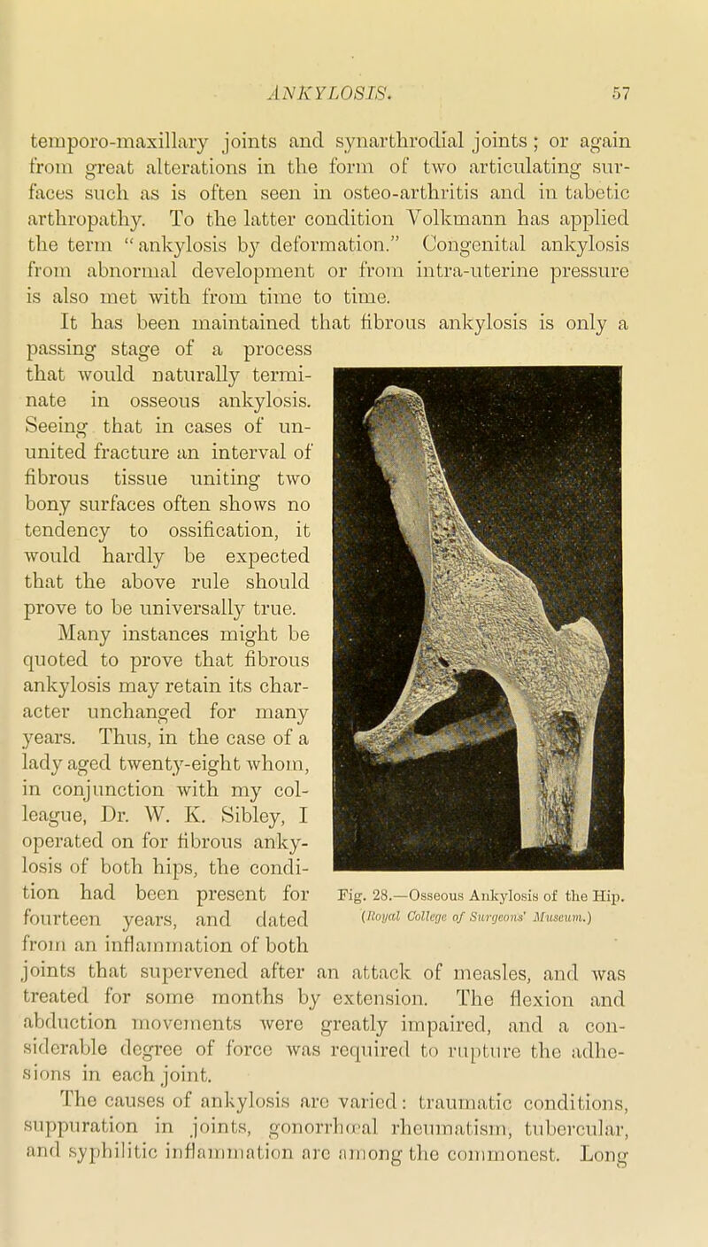 teinporo-maxillary joints and synarthrodia! joints ; or again from great alterations in the form of two articulating sur- faces such as is often seen in osteo-arthritis and in tabetic arthropathy. To the latter condition Volkmann has applied the term  ankylosis by deformation. Congenital ankylosis from abnormal development or from intra-uterine pressure is also met with from time to time. It has been maintained that fibrous ankylosis is only a passing stage of a process that would naturally termi- nate in osseous ankylosis. Seeing that in cases of un- united fracture an interval of fibrous tissue uniting two bony surfaces often shows no tendency to ossification, it would hardly be expected that the above rule should prove to be universally true. Many instances might be quoted to prove that fibrous ankylosis may retain its char- acter unchanged for many years. Thus, in the case of a lady aged twenty-eight whom, in conjunction with my col- league, Dr. W. K. Sibley, I operated on for fibrous anky- losis of both hips, the condi- tion had been present for Fig. 28.—Osseous Ankylosis of the Hip. fourteen years, and dated XRoyal ColUge of surgeons' Museum.) froiri an inflammation of both joints that supervened after an attack of measles, and was treated for some months by extension. The flexion and abduction movejnents were greatly impaired, and a con- siderable degree of force was required to rapture the adhe- sions in each joint. The causes of ankylosis are varied: traumatic conditions, suppuration in joints, gonorrha-al rheumatism, tubercular, and syphilitic inflairnnation arc .'Uiiong the coiimionest. Long