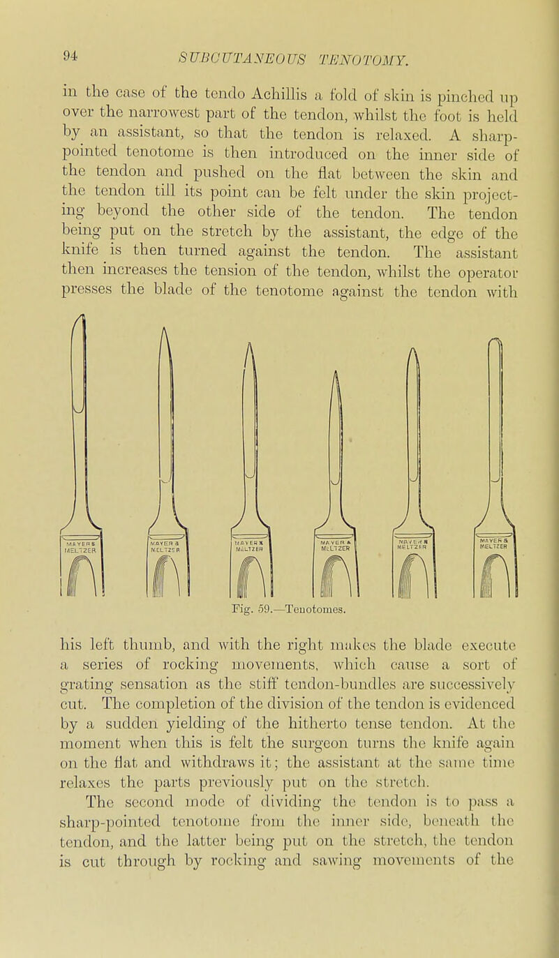 SUBCUTANEOUS TENOTOMY. in the case of the tendo Achillis a fold of slvin is pinclied up over the narrowest part of the tendon, whilst the foot is held by an assistant, so that the tendon is relaxed. A sharp- pointed tenotome is then introduced on the inner side of the tendon and pushed on the flat between the skin and the tendon till its point can be felt under the skin project- ing beyond the other side of the tendon. The tendon being put on the stretch by the assistant, the edge of the knife is then turned against the tendon. The assistant then increases the tension of the tendon, whilst the operator presses the blade of the tenotome against the tendon with rig. 59.—Tenotomes. his left thumb, and with the right makes the blade execute a series of rocking movements, which cause a sort of grating sensation as the stiff tendon-bundles are successively cut. The completion of the division of the tendon is evidenced by a sudden yielding of the hitherto tense tendon. At the moment when this is felt the surgeon turns the knife again on the flat and withdraws it; the assistant at the same time relaxes the parts previously put on the stretch. The second mode of dividing the tendon is to pass a sharp-pointed tenotome from the inner side, beneath the tendon, and the latter being put on the stretch, the tendon is cut through by rocking and sawing movements of the