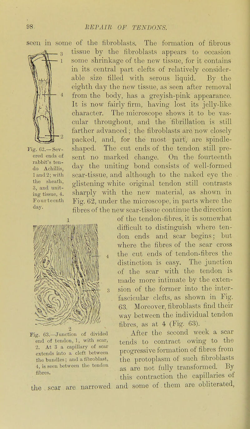 Fig. 62.—Sev- ered ends of rabbit's ten- do Achillis, 1 and 2; with the sheath, 3, and unit- ing tissue, 4. Fourteenth day. seen in some of the hbroblusts. The formation of fibrous tissue by the fibroblasts appears to occasion some shrinkage of the new tissue, for it contains in its central part clefts of relatively consider- able size filled with serous liquid. By the eighth day the new tissue, as seen after removal from the body, has a greyish-pink appearance. It is now fairly firm, having lost its jelly-like character. The microscope shows it to be vas- cular throughout, and the fibrillation is still farther advanced; the fibroblasts are now closely packed, and, for the most part, are spindle- shaped. The cut ends of the tendon still pre- sent no marked change. On the fourteenth day the uniting bond consists of well-formed scar-tissue, and although to the naked eye the glistening Avhite original tendon still contrasts sharply with the new material, as shown in Fig. 62, under the microscope, in parts where the fibres of the new scar-tissue continue the direction of the tendon-fibres, it is somewhat difiicult to distinguish where ten- don ends and scar begins; but Avhere the fibres of the scar cross the cut ends of tendon-fibres the distinction is easy. The junction of the scar with the tendon is made more intimate by the exten- sion of the former into the inter- fascicidar clefts, as shown in Fig. 63. Moreover, fibroblasts find their way between the individual tendon fibres, as at 4 (Fig. 63). After the Second week a scar tends to contract owing to the progressive formation of fibres from the protoplasm of such fibroblasts as are not fully transformed. By this contraction the capillaries of and some of them are obliterated, Fig. 63.—Junction of divided end of tendon, 1, with scar, 2. At 3 a capillary of scar extends into a cleft between the bundles; and a fibroblast, 4, is seen between tlie tendon fibres. the scar are narr owed