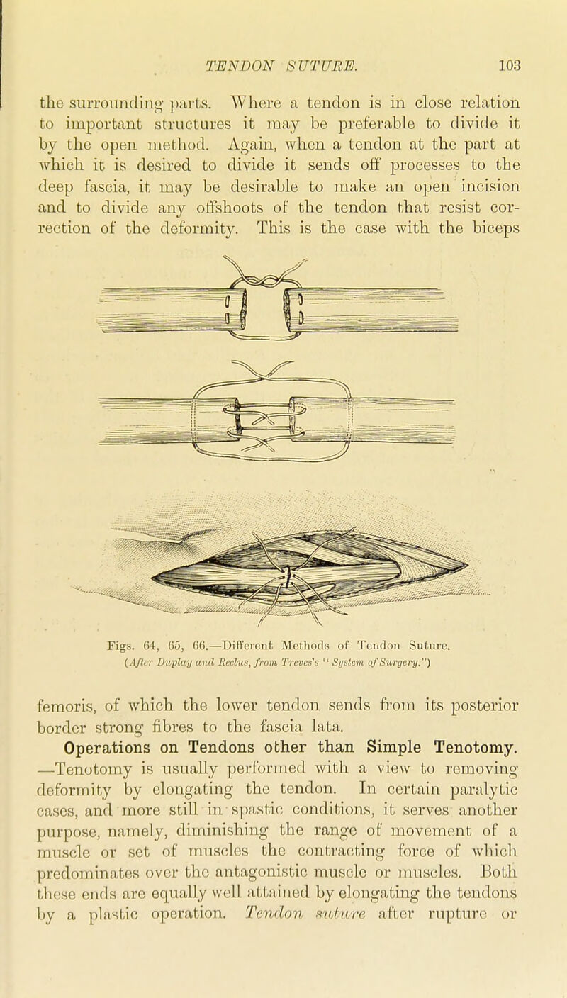 the surrounding parts. Whore a tendon is in close rehxtion to important structures it may be preferable to divide it by the open method. Again, when a tendon at the part at which it ia desired to divide it sends ofE processes to the deep fascia, it may be desirable to make an open incision and to divide any offshoots of the tendon that resist cor- rection of the deformity. This is the case with the biceps Figs. 64, 65, 66.—Different Methods of Tendon Sutui'e. (After Daplay and Radus, from Treves's  Si/stem of Surgery.) feraoris, of which the lower tendon sends from its posterior border strong fibres to the fascia lata. Operations on Tendons other than Simple Tenotomy. —Tenotomy is usually performed with a view to removing deformity by elongating the tendon. In certain paralytic cases, and more still in spastic conditions, it serves-another purpose, namely, diminishing the range of movement of a muscle or set of muscles the contracting force of which predominates over the antagonistic mviscle or umscles. Both these ends arc equally well attained by elongating the tendons by a plastic operation. Tendon mdiire after rupture or