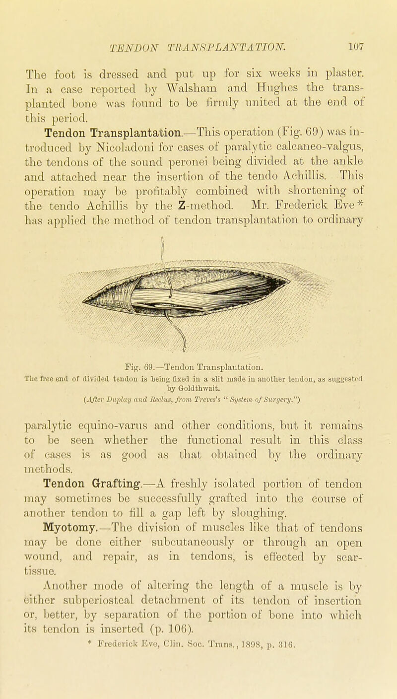 The foot is dressed and put up for six weeks in plaster. In a case reported by Walsliam and Hughes the trans- planted bone was found to be firmly united at the end of this period. Tendon Transplantation.—This operation (Fig. 69) was in- troduced by Nicoladoui for cases of paralytic calcaneo-valgus, the tendons of the sound peronei being divided at the ankle and attached near the insertion of the tendo Achillis. This operation may be profitably combined with shortening of the tendo Achillis by the Z-method. Mr. Frederick Eve* has applied the method of tendon transplantation to ordinary rip;. 69.—Tendon Transplantation. The free end of divicIeJ tendon is 'being fixed in a slit made in anotlier tendon, as suggested by Gold til wait. (After Duplay and Seclus, from Treves's  System of Surgery.) paralytic equino-varus and other conditions, but it remains to be seen whether the functional result in this class of cases is as good as that obtained by the ordinary methods. Tendon Grafting.—A freshly isolated portion of tendon may sometimes be successfully grafted into the course of another tendon to fill a gap left by sloughing. Myotomy.—The division of muscles like that of tendons rnay be done either subcutaneously or through an open wound, and repair, as in tendons, is effected by scar- tissue. Another mode of altering the length of a muscle is by either subperiosteal detachment of its tendon of insertion or, better, by separation of the portion of bone into which its tendon is inserted (p. lOG). * Fredcii-ick Eve, Gliri. Soc. 'J'riinH., 18!)S, p. ;ilG.