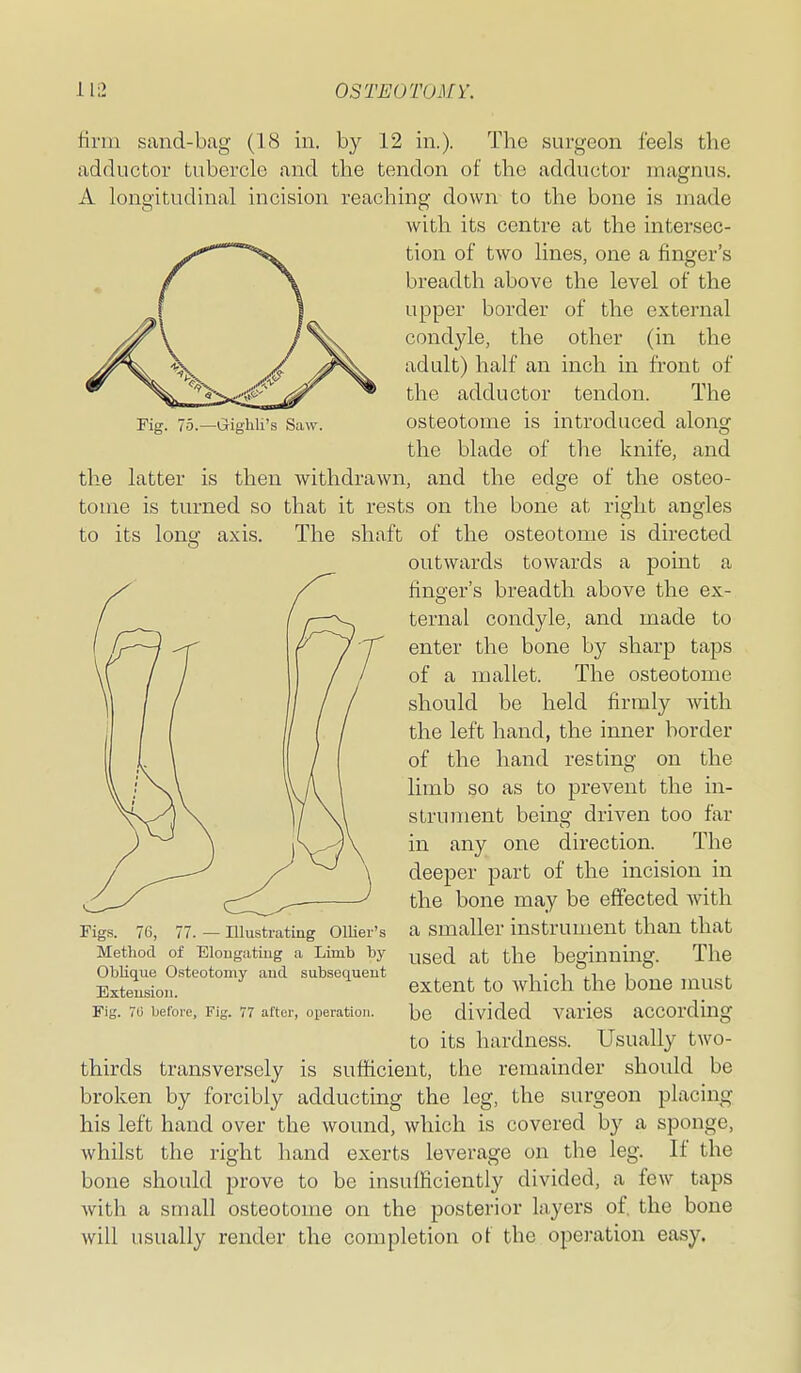 Fig. 75.—Giglili's Saw. firm sand-bag (18 in. by 12 in.). The surgeon feels the adductor tubercle and the tendon of the adductor magnus. A longitudinal incision reaching down to the bone is made with its centre at the intersec- tion of two lines, one a finger's breadth above the level of the upper border of the external condyle, the other (in the adult) half an inch in front of the adductor tendon. The osteotome is introduced alongr the blade of the knife, and the latter is then withdrawn, and the edge of the osteo- tome is turned so that it rests on the bone at right angles to its long axis. The shaft of the osteotome is directed outwards towards a point a finger's breadth above the ex- ternal condyle, and made to enter the bone by sharp taps of a mallet. The osteotome should be held firmly with the left hand, the inner border of the hand resting on the limb so as to prevent the in- strument being driven too far in any one direction. The deeper part of the incision in the bone may be effected with a smaller instrument than that Method of Elongatiug a Limb by ^gg(j the beginning. The Oblique Osteotomy and. subsequent , , , i ■ i i i. Extension. extent to which the bone must FiiJ. 70 befoie. Fig. 77 after, operation. be divided VaricS aCCOrdiug to its hardness. Usually two- thirds transversely is sufficient, the remainder should be broken by forcibly adducting the leg, the surgeon placing his left hand over the wound, which is covered by a sponge, whilst the right hand exerts leverage on the leg. If the bone should prove to bo insufficiently divided, a few taps with a small osteotome on the posterior layers of, the bone will usually render the completion of the opei-ation easy. 76, 77. — Illustrating Ollier's