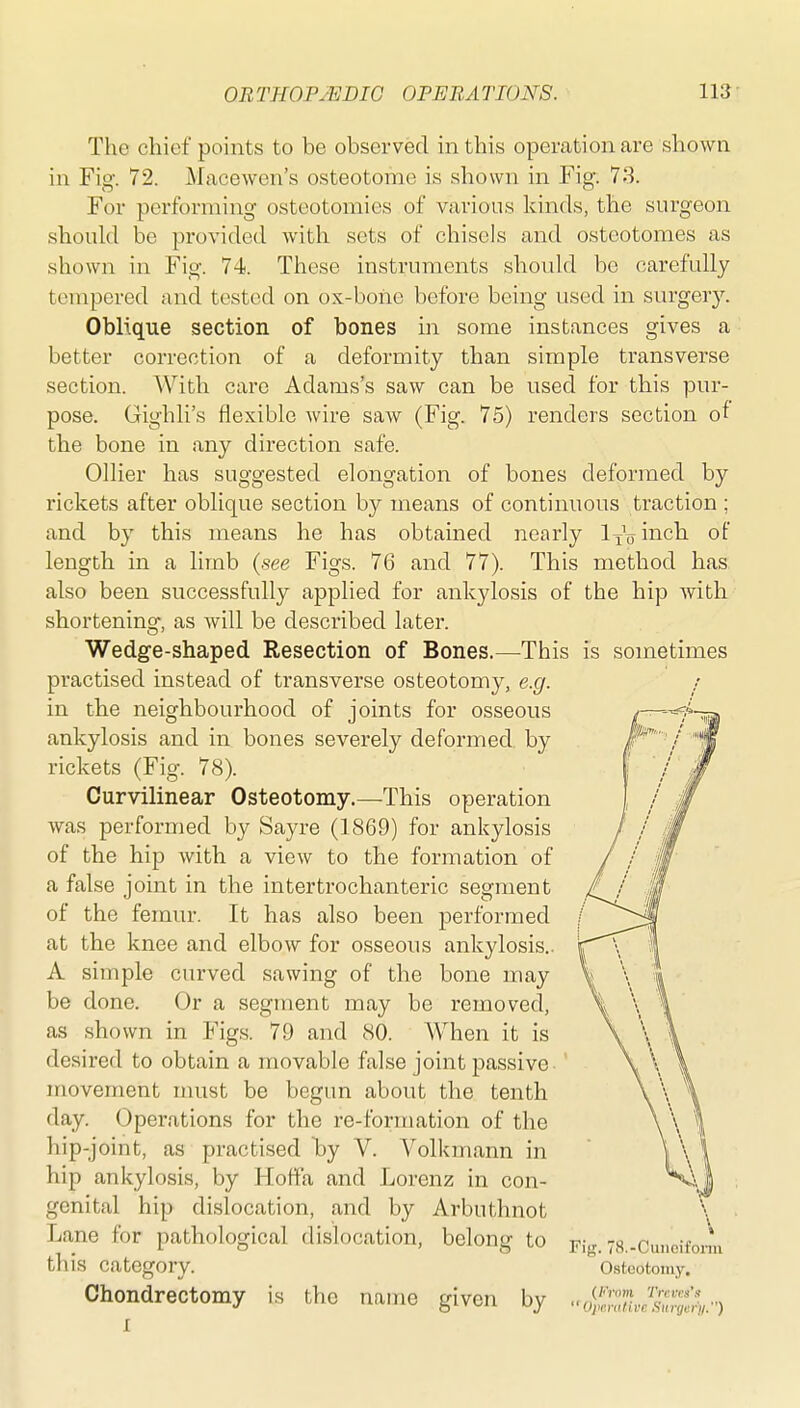 The chief points to be observed in this operation are shown in Fig. 72. Macewcn's osteotome is shown in Fig. 78. For performing osteotomies of various kinds, the surgeon shoukl be provided with sets of chisels and osteotomes as shown in Fig. 74. These instruments shoukl be carefully tempered and tested on ox-bone before being used in surger}''. Oblique section of bones in some instances gives a better correction of a deformity than simple transverse section. With care Adams's saw can be used for this pur- pose. Gighli's flexible wire saw (Fig. 75) renders section of the bone in any direction safe. Oilier has suggested elongation of bones deformed by rickets after oblique section by means of continuous traction ; and by this means he has obtained nearly l^ViJicli of length in a limb {see Figs. 76 and 77). This method has also been successfully applied for ankylosis of the hip with shortening, as will be described later. Wedge-shaped Resection of Bones.—^This is sometimes practised instead of transverse osteotomy, e.g. in the neighbourhood of joints for osseous ankylosis and in bones severely deformed, by rickets (Fig. 78). Curvilinear Osteotomy.—This operation was performed by Sayre (1869) for ankylosis of the hip with a view to the formation of a false joint in the intertrochanteric segment of the femur. It has also been performed at the knee and elbow for osseous ankylosis.. A simple curved sawing of the bone may be done. Or a segment may be removed, as shown in Figs. 79 and 80. When it is desired to obtain a movable false joint passive movement nuist be begim about the tenth day. Operations for the re-formation of the hip-joint, as practised by V. Volkmann in hip ankylosis, by Hoffa and Lorenz in con- genital hip dislocation, and by Arbuthnot Lane for pathological dislocation, belong to this category, Chondrectomy 1 is the name given by Fig. 78.-Cuneifonn Osteotomy. (/'Voni Treves's  Opcnitivc Surger'ji.)