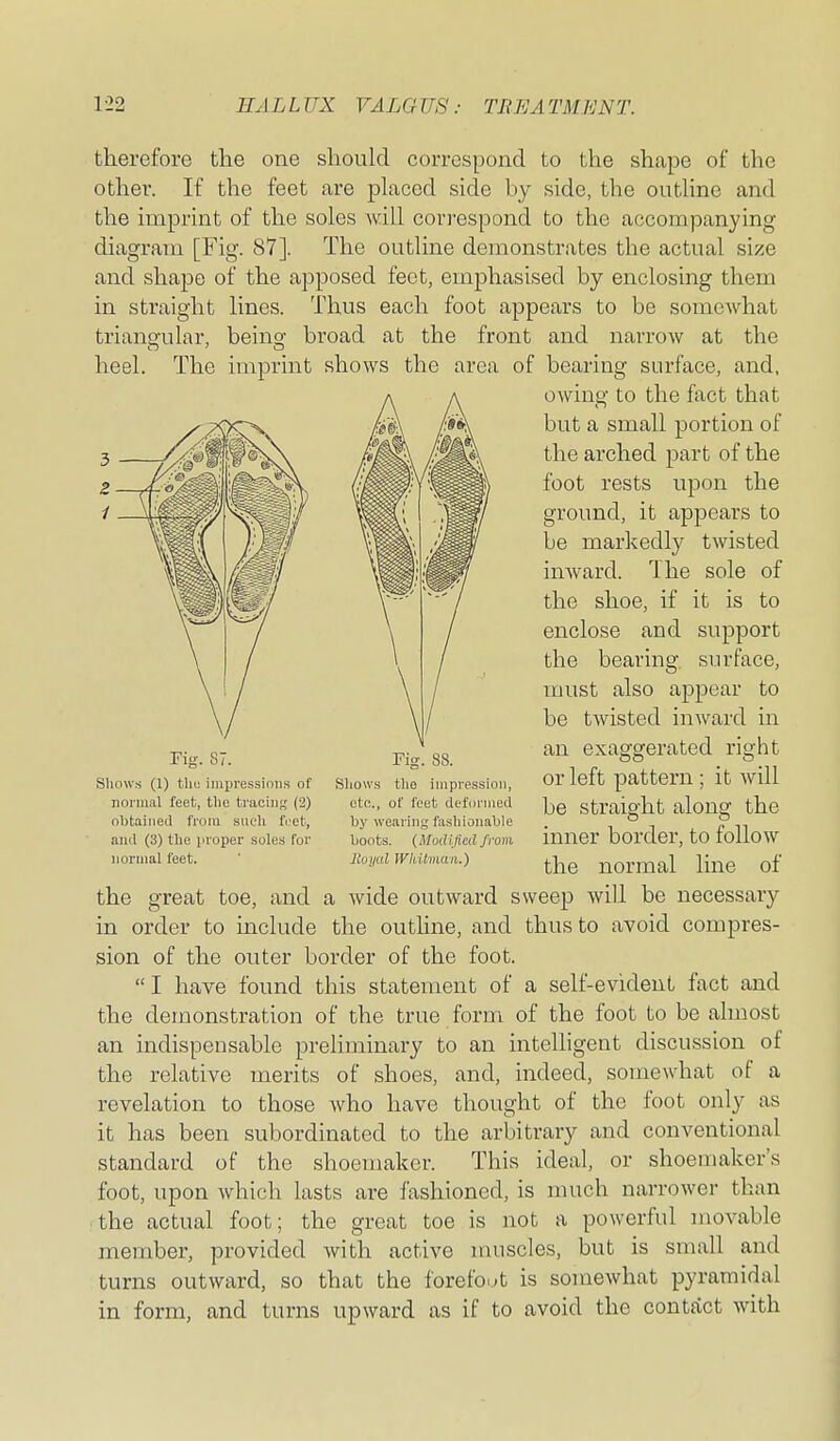 therefore the one should corrGspond to the shape of the other. If the feet are placed side by side, the outline and the imprint of the soles will correspond to the accompanying diagram [Fig. 87]. The outline demonstrates the actual size and shape of the apposed feet, emphasised by enclosing them in straight lines. Thus each foot appears to be somewhat trianp-ular, beinof broad at the front and narrow at the heel. The imprint shows the area of bearing surface, and, owing to the fact that but a small portion of the arched part of the foot rests upon the ground, it appears to be markedly twisted inward. The sole of the shoe, if it is to enclose and support the bearing si irface, must also appear to be twisted inward in an exaggerated right or left pattern ; it will be straight along the inner border, to follow the normal line of the great toe, and a wide outward sweep will be necessary in order to include the outline, and thus to avoid compres- sion of the outer border of the foot. I have found this statement of a self-evident fact and the demonstration of the true form of the foot to be almost an indispensable preliminary to an intelligent discussion of the relative merits of shoes, and, indeed, somewhat of a revelation to those who have thought of the foot only as it has been subordinated to the arbitrary and conventional standard of the shoemaker. This ideal, or shoemaker's foot, upon which lasts are fashioned, is much narrower than the actual foot; the great toe is not a powerful movable member, provided with active muscles, but is small and turns outward, so that the forefo-t is somewhat pyramidal in form, and turns upward as if to avoid the contact with Fig. 87. Shows (1) the imijressions of nonual feet, the traciiif? (2) obtained fioiii such foet, and (3) the proper soles for normal feet. Fig. 88. Shows the impression, ete., of feet deformed by wearing fashionable boots. (Modified from Royal Whitman.)