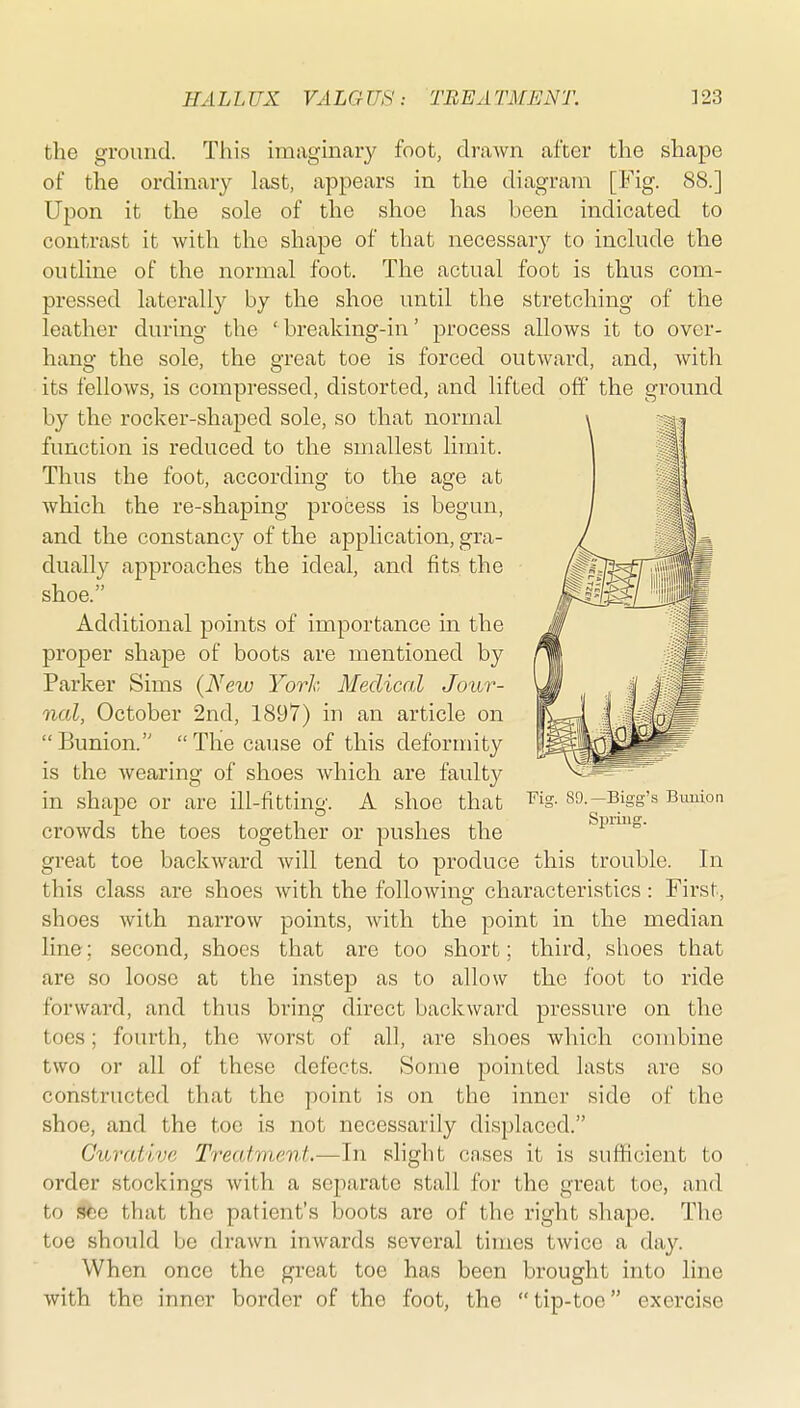 the ground. This imaginary foot, drawn after the shape of the ordinary last, appears in the diagram [Fig. 88.] Upon it the sole of the shoe has been indicated to contrast it with the shape of that necessary to include the outline of the normal foot. The actual foot is thus com- pressed laterally by the shoe until the stretching of the leather during the ' breaking-in' process allows it to over- hang the sole, the great toe is forced outward, and, Avith its fellows, is compressed, distorted, and lifted off the ground by the rocker-shaped sole, so that normal function is reduced to the smallest limit. Thus the foot, according to the age at which the re-shaping process is begun, and the constancy of the application, gra- dually approaches the ideal, and fits the shoe. Additional points of importance in the proper shape of boots are mentioned by Parker Sims {New York Medical Jour- nal, October 2nd, 1897) in an article on Bunion. The cause of this deformity is the wearing of shoes which are faulty in shape or are ill-fitting. A shoe that '^'^s- so.-Bigg's Bmiion crowds the toes together or pushes the Spnuo. great toe backward will tend to produce this trouble. In this class are shoes with the following characteristics : First, shoes with narrow points, with the point in the median line; second, shoes that are too short; third, shoes that are so loose at the instep as to allow the foot to ride forward, and thus bring direct backward pressure on the toes; fourth, the worst of all, are shoes which combine two or all of these defects. Some pointed lasts are so constructed that the point is on the inner side of the shoe, and the toe is not necessarily displaced. CuraUve Treatment.-—In slight cases it is sufficient to order stockings with a separate stall for the great toe, and to ^e that the patient's boots are of the right shape. The toe should bo drawn inwards several times twice a day. When once the great toe has been brought into line with the inner border of the foot, the tip-toe exercise