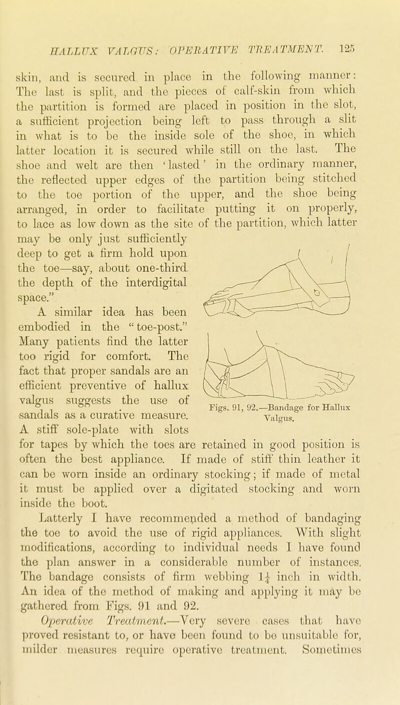 skin, and is secured in place in the following manner: The last is split, and the pieces of calf-skin from which the partition is formed are placed in position in the slot, a sufficient projection being left to pass through a slit in what is to be the inside sole of the shoe, in which latter location it is secured while still on the last. The shoe and welt are then 'lasted' in the ordinary manner, the reflected upper edges of the partition being stitched to the toe portion of the upper, and the shoe being arranged, in order to facilitate putting it on properly, to lace as low down as the site of the partition, which latter may be only just sufficiently deep to get a firm hold upon the toe—say, about one-third, the depth of the interdigital space. A similar idea has been embodied in the  toe-post. Many patients find the latter too rigid for comfort. The fact that proper sandals are an efficient preventive of hallux valgus suggests the use of sandals as a curative measure. A stiff sole-plate with slots for tapes by which the toes are retained in good position is often the best appliance. If made of stiff thin leather it can be worn inside an ordinary stocking; if made of metal it must be applied over a digitated stocking and worn inside the boot. Latterly I have recommended a method of bandaging the toe to avoid the use of rigid appliances. With slight modifications, according to individual needs I have found the plan answer in a considerable number of instances. The bandage consists of firm webbing 1\ inch in width. An idea of the method of making and applying it may be gathered from Figs. 91 and 92. Operative Treatment.—Very severe cases that have proved resistant to, or have been found to bo unsuitable for, milder measures require operative treatment. Sometimes Figs. 91, 92.—Bandage for Hallux Valgus.