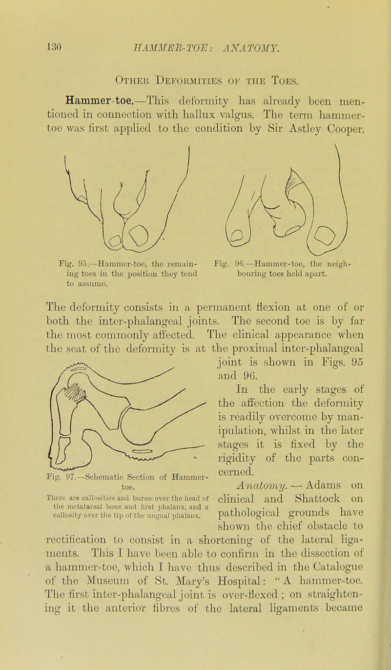 Other Defoiimities of the Toes. Hammer-toe.—This deformity lias already been men- tioned in connection witli hallux valgus. The term hammer- toe was first ajDplied to the condition by Sir Astley Cooper. \ Fig. 95.—Hammer-toe, the remain- ing toes in the position they teucl to assume. 96.—Hammer-toe, the neigh- bouring toes held apai-t. The deformity consists in a permanent flexion at one of or both the inter-phalangeal joints. The second toe is by far the most commonly affected. The clinical appearance when the seat of the deformity is at the proximal inter-phalangeal joint is shoAvn in Figs. 95 and 96. In the early stages of the aifection the deformity is readily overcome by man- ipulation, whilst in the later stages it is fixed by the rigidity of the parts con- cerned. Anatomy. — Adams on clinical and Shattock on pathological grounds have shown the chief obstacle to rectification to consist in a shortening of the lateral liga- ments. This I have been able to confirm in the dissection of a hammer-toe, which I have thus described in the Catalogue of the Museum of St. Mary's Hospital: A hammcr-toe. The first inter-phalangeal joint is over-fiexed ; on straighten- it the anterior fibres of the lateral lisfamcnts became 97.—Schematic Section of Hammer- toe. There are callosities and biirsie, over the head of the metatarsal bone and lirst phalanx, and a callosity over the tip of the uiigiwil phalanx. mg