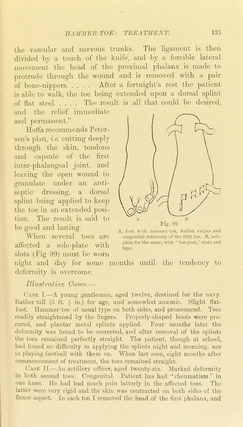 the ViisculiU* and nervous trunks. The Hgainent is then divided by a touch of the knife, and by a forcible lateral movouient the head of the proxhnal phalanx is made to protrude through the wound and is removed with a pair of bone-nippers. .... After a fortnight's rest the patient is able to walk, the toe being extended upon a dorsal splint of flat steel The result is all that could be desired, and the relief immediate and permanent. Hott'a recommends Peter- sen's plan, i.e. cutting deeply through the skin, tendons and capsule of the first inter-phalangeal joint, and leaving the open wound to granulate under an anti- septic dressing, a dorsal splint being applied to keep the toe in an extended posi- tion. The result is said to be good and lasting. When several toes are affected a sole-plate with slots (Fig 99) must be worn night and day for some months until the tendency to deformity is overcome. Illustrative Gases.— Case I.—A young gentleman, aged twelve, destined for the navy. Rather tall (.) ft. h in.) for age, and somewhat an;emic. Slight flat- foot. Hammer-toe of usual type on both sides, and pronounced. Toes readily straightened by the fingers. Pro])erly-.sliaped boots were pro- cured, and plantar metal splints applied. Four months later the deformity was found to be corrected, and after removal of the splints the toes remained perfectly straight. The ])atient, though at scliool, had found no difficulty in applying the splints night and morning, nor in playing football with them on. When last seen, eight months after commencement of treatment, the toes remained straight. Case II.—An artillery officer, aged twenty-six. IVFarked deformity in both second toes. Congenital. Patient has had rheumatism in one knee. He had had much pain latterly in the afl'ected toes. The latter were very rigid and tlie skin was contracted on both sides of the flexor aspect. In each toe I removed the head of the first phalanx, and A B Fig. 99. A, foot With hauniier-toe, lialliix valRUri and congenital deformity of the liftli toe. B, .sole- l)latefor the same, witli toe-post, slots and tape.