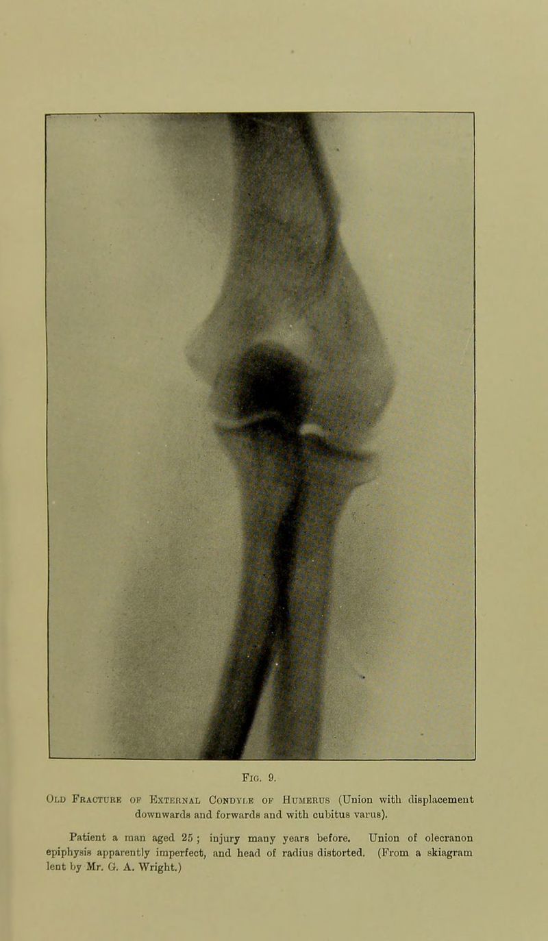 Old Fracture op External CoNDvr.E of Humerus (Union with displacement downwards and forwards and with cubitus varus). Patient a raan aged 25 ; injury many years before. Union of olecranon epiphysis apparently imperfect, and head of radius distorted. (From a skiagram lent by Mr. G. A. Wright.)