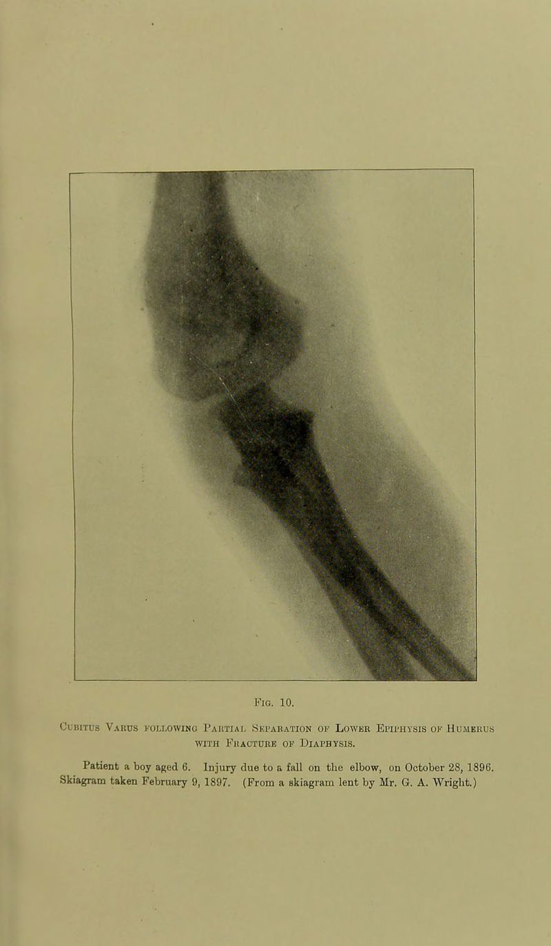 Cubitus Varus following Pahtial Sei'ak.ation of Lower Epiphysis ok Humerus WITH Fracture of Diafhysis. Patient a boy aged 6. Injury due to a fall on the elbow, on October 28, 1896.