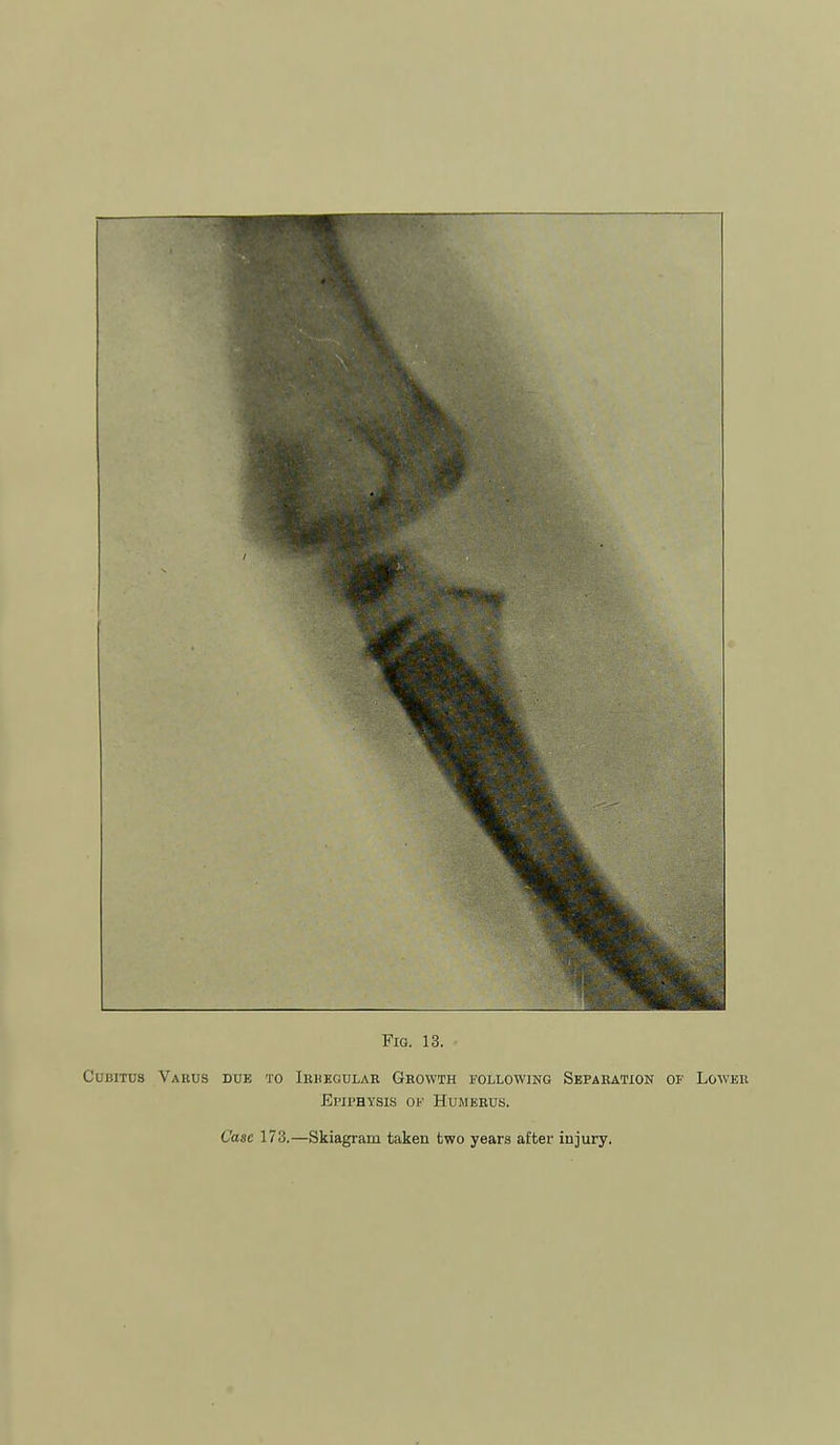Cubitus Varus due to Iuiieodlar Growth following Separation of Lower Ei'ii'HYSis OF Humerus.