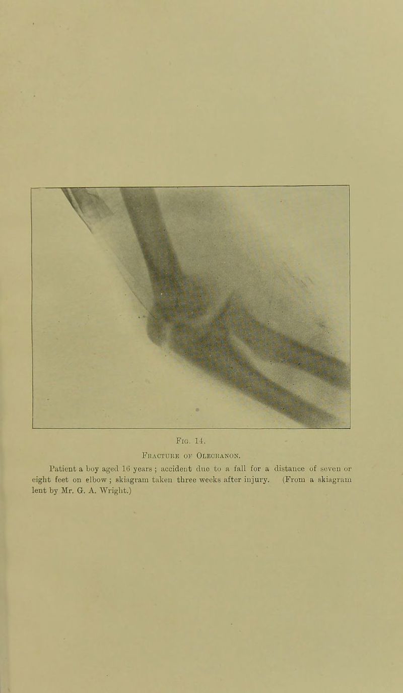 Fbactuue of Oleci!anon. Patient a boy aged 1(3 years ; accident duo to a fall for a distance of seven or eight feet on elbow ; skiagram taken three weeks after injury. (From a skiagram lent by Mr. G. A. Wright.)
