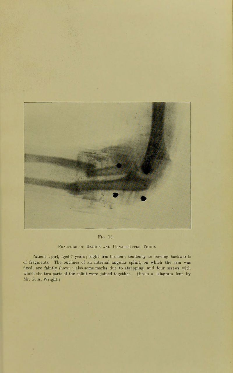 Fracture of IIadius and Ulna—Ufi'ek Third. I'atieut a girl, aged 7 years ; right arm broken ; tendency to bowiug backwards ot fragments. The outlines of an internal angular splint, on which the arm was fixed, are faintly shown ; also some marks due to strapping, and four screws with which the two parts of the splint were joined together. (From a skiagram lent by Mr. G. A. Wright.)