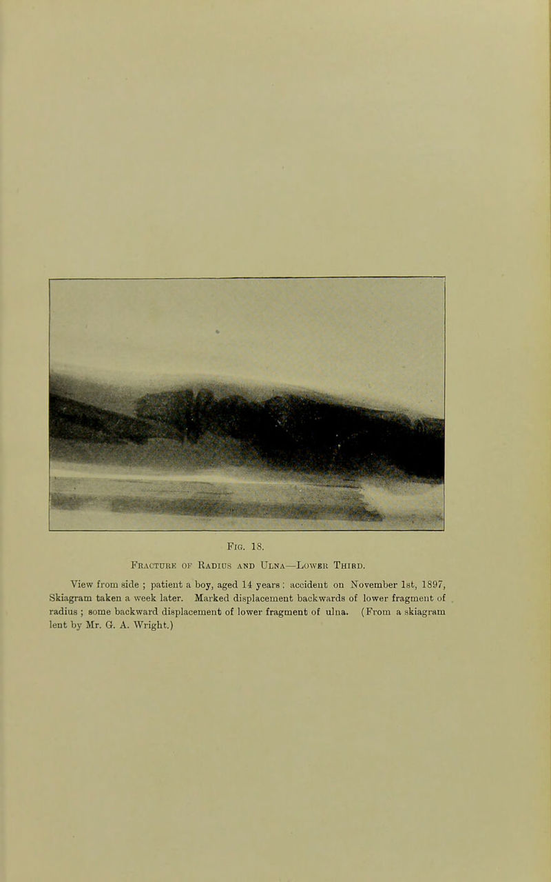 Fhactube of Radios and Ulna—LowBii Third. View from side ; patient a boy, aged 14 years ; accident on November Ist, 1897, Skiagram taken a week later. Marked displacement backwards of lower fragment of radius; some backward displacement of lower fragment of ulua. (From a skiagram lent by Mr. G. A. Wright.)