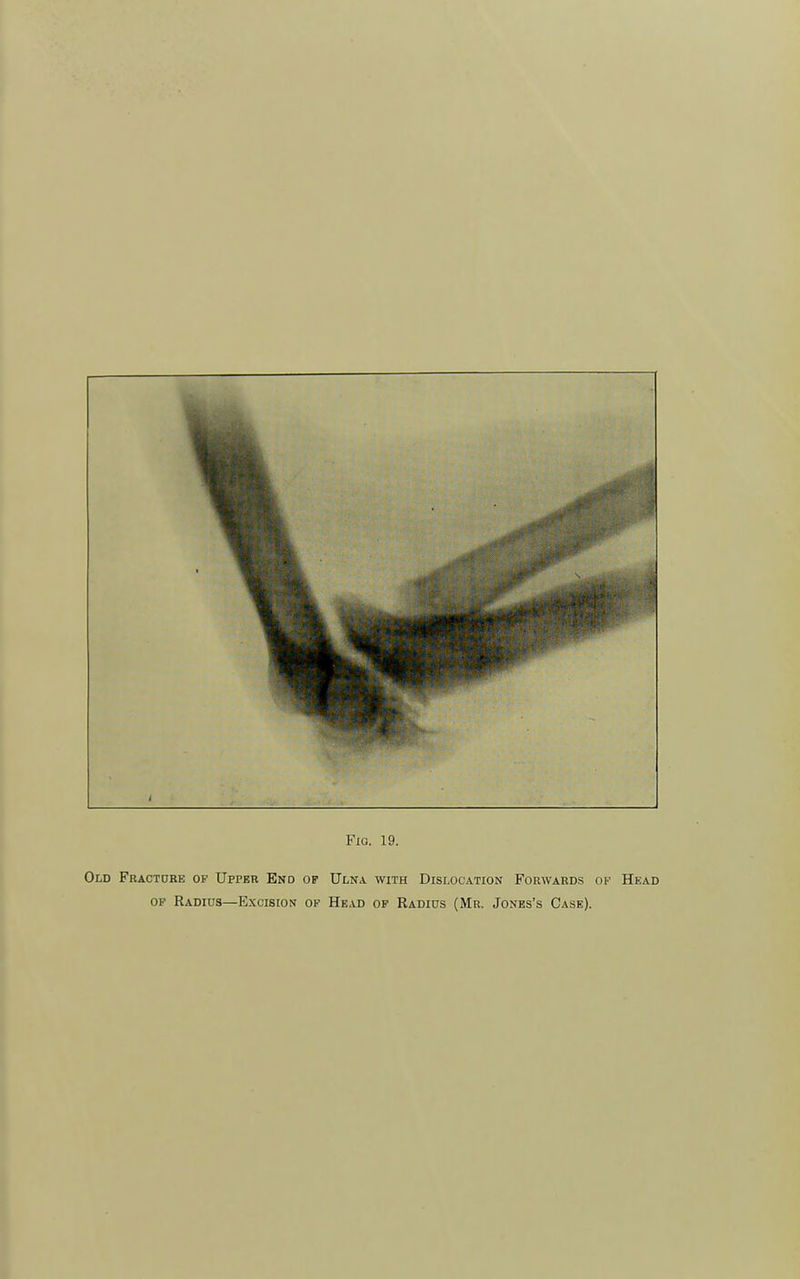 Fig. 19. Old Fractore of Upper End op Ulna with Dislocation Forwards oi' Head OF Radius—Excision op Head op Radius (Mr. Jones's Case).