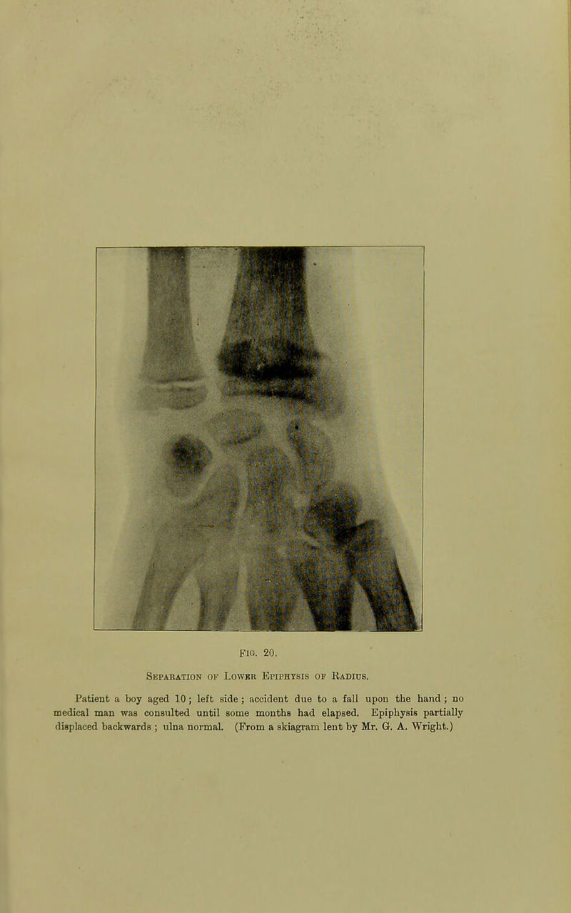 Separation of Lowkr Epiphysis of Radius. Patient a boy aged 10 ; left side; accident due to a fall upon the hand ; no medical man was consulted until some months had elapsed. Epiphysis partially displaced backwards ; ulna normal. (From a skiagram lent by Mr. 6. A. Wright.)