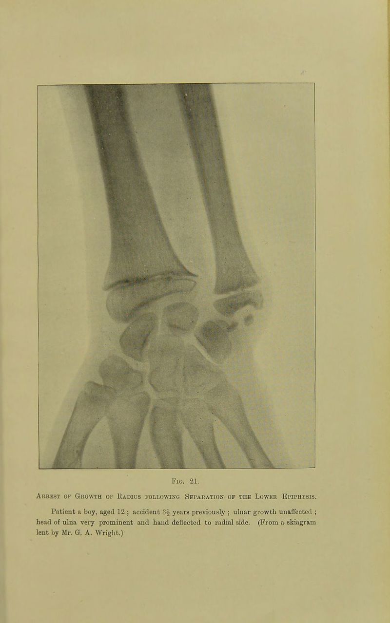 Akrest of Growth op Radius following Separation op the Lower Epiphysis. Patient a boy, aged 12 ; accident 3^ years previously ; ulnar growth unaffected ; head of ulna very prominent and hand deflected to radial side. (From a skiagram lent by Mr. G. A. Wright.)