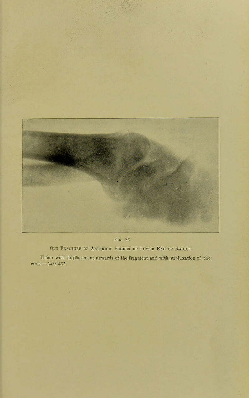 Fig. 23. Old Fracttire op Anterior Border of Lowkr End of Radius. Union with displacement upwards of the fragment and with subluxation of the wrist.—Case 561.