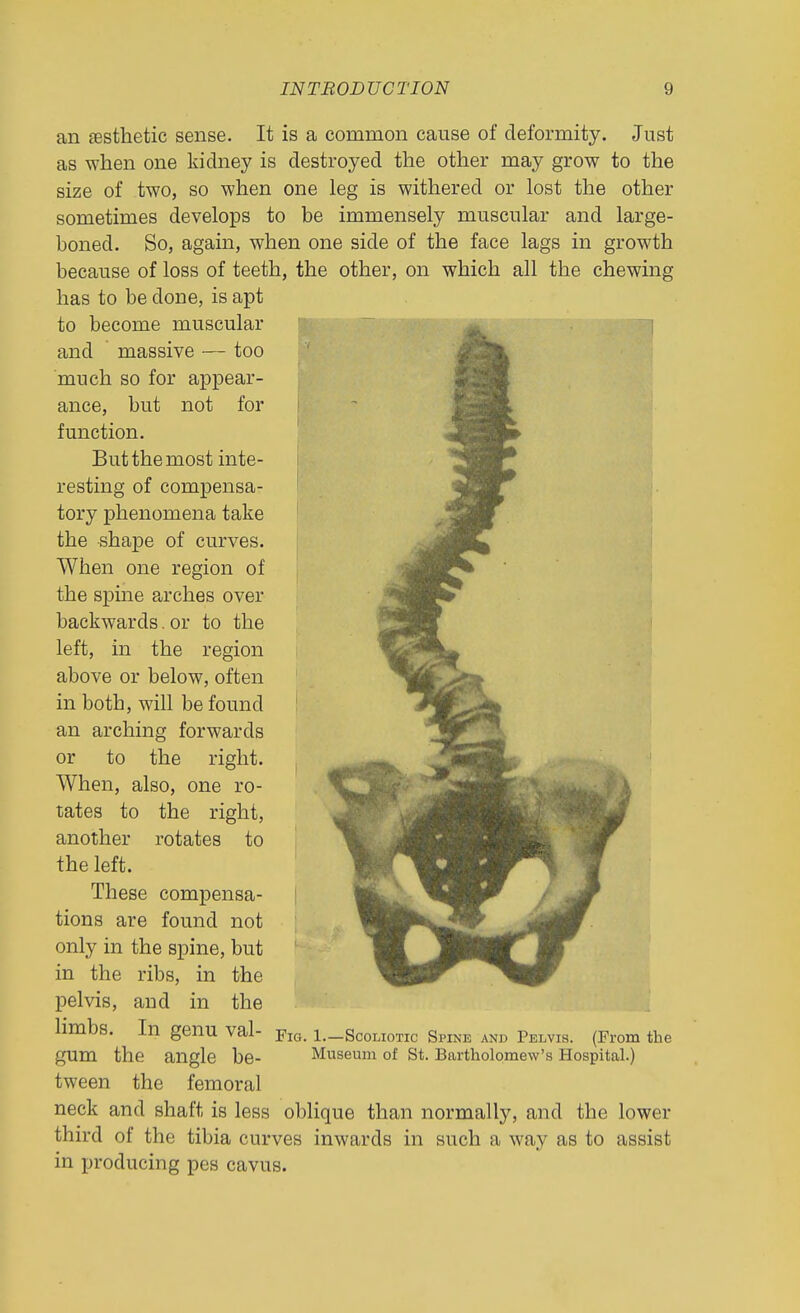 an £esthetic sense. It is a common cause of deformity. Just as when one kidney is destroyed the other may grow to the size of two, so when one leg is withered or lost the other sometimes develops to be immensely muscular and large- boned. So, again, when one side of the face lags in growth because of loss of teeth, the other, on which all the chewing has to be done, is apt to become muscular ~ j» and massive — too much so for appear- ance, but not for function. But the most inte- resting of compensa- tory phenomena take the shape of curves. When one region of the spine a,rches over backwards, or to the left, in the region above or below, often in both, will be found an arching forwards or to the right. When, also, one ro- tates to the right, another rotates to the left. These compensa- tions are found not only in the spine, but in the ribs, in the pelvis, and in the limbs. In genu val- gum the angle be- tween the femoral neck and shaft is less oblique than normally, and the lower third of the tibia curves inwards in such a way as to assist in producing pes cavus. Fig. 1.—Scoliotic Spine and Pelvis. (From the Museum of St. Bartholomew's Hospital.)