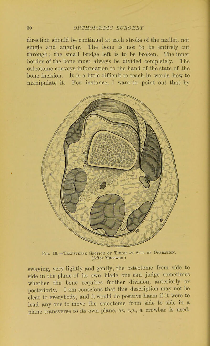 direction should be continual at each stroke of the mallet, not single and angular. The bone is not to be entirely cut through; the small bridge left is to be broken. The inner border of the bone must always be divided completely. The osteotome conveys information to the hand of the state of the bone incision. It is a little difficult to teach in words how to manipulate it. For instance, I want to point out that by Fig. 16.—Tbansveese Section op Thigh at Site of Operation. (After Macewen.) swaying, very hghtly and gently, the osteotome from side to side in the plane of its own blade one can judge sometimes whether the bone requires further division, anteriorly or posteriorly. I am conscious that this description may not be clear to everybody, and it would do positive harm if it were to lead any one to move the osteotome from side to side in a plane transverse to its own plane, as, c.<i., a crowbar is used.