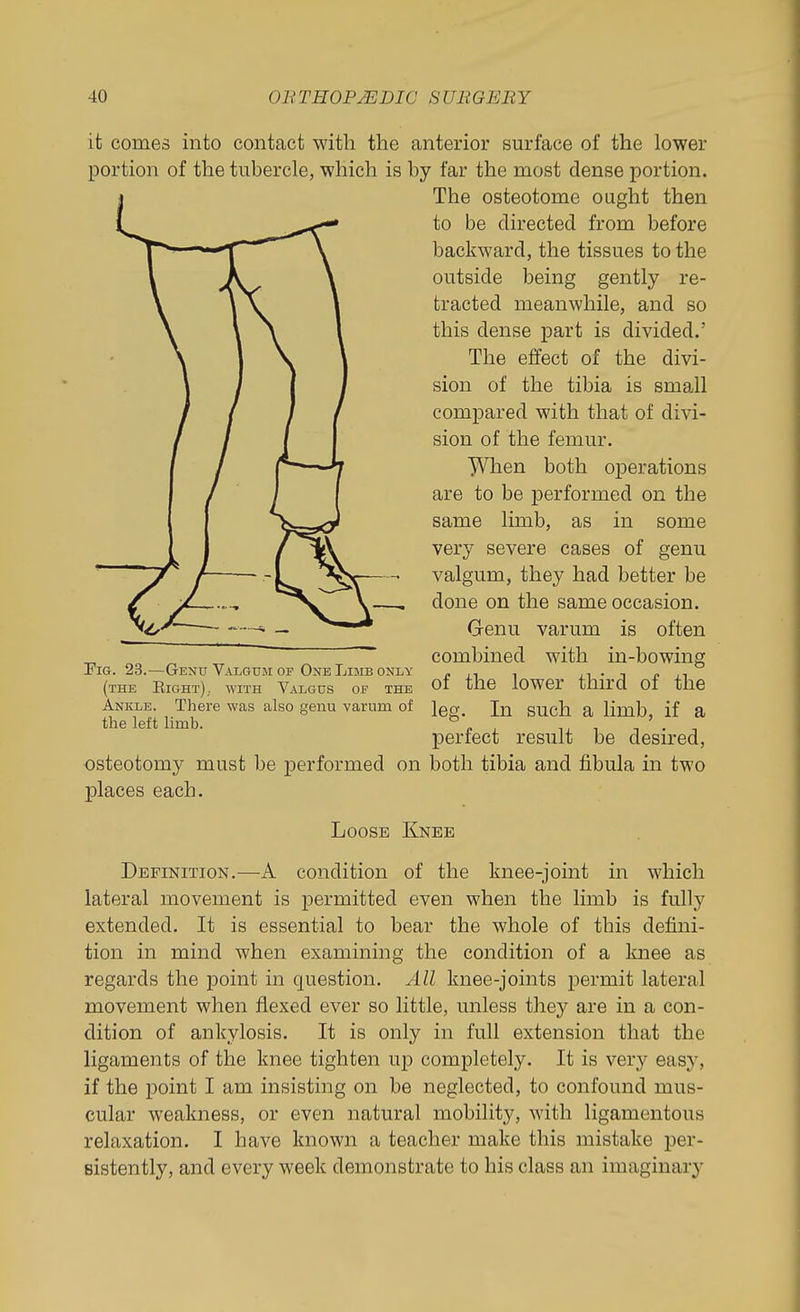 it comes into contact with the anterior surface of the lower portion of the tubercle, which is by far the most dense portion. The osteotome ought then to be directed from before backward, the tissues to the outside being gently re- tracted meanwhile, and so this dense part is divided.' The effect of the divi- sion of the tibia is small compared with that of divi- sion of the femur. JVhen both operations are to be performed on the same limb, as in some very severe cases of genu valgum, they had better be done on the same occasion. Genu varum is often combined with in-bowing of the lower third of the leg. In such a limb, if a perfect result be desired, osteotomy must be performed on both tibia and fibula in two places each. Loose Knee Definition.—A condition of the knee-joint in which lateral movement is permitted even when the limb is fully extended. It is essential to bear the whole of this defini- tion in mind when examining the condition of a knee as regards the point in question. All knee-joints permit lateral movement when flexed ever so little, unless they are in a con- dition of ankylosis. It is only in full extension that the ligaments of the knee tighten up completely. It is very easy, if the point I am insisting on be neglected, to confound mus- cular weakness, or even natural mobility, with ligamentous relaxation. I have known a teacher make this mistake per- sistently, and every week demonstrate to his class an imaginary Pig. 23.—Genu Valgum op One Limb only (the Right)., with Valgus of the Ankle. There was also genu varum of the left limb.