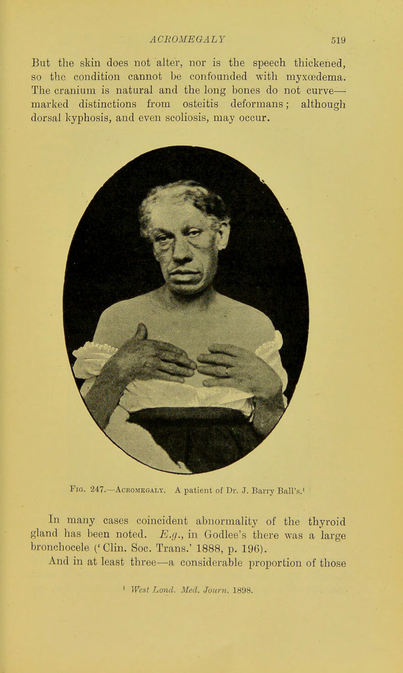 But the skin does not alter, nor is the speech thickened, so the condition cannot he confounded with myxoedema. The cranium is natural and the long bones do not curve— marked distinctions from osteitis deformans; although dorsal kyphosis, and even scoliosis, may occur. Fig. 247.—Acromegaly. A patient of Dr. ,J. Barry Ball's.' In many cases coincident abnormality of the thyroid gland has been noted. E.g., in Godlee's there was a large bronchocele ('Clin. Soc. Trans.' 1888, p. 196). And in at least three—a considerable proportion of those ' West Land. Med. Journ. 1898.