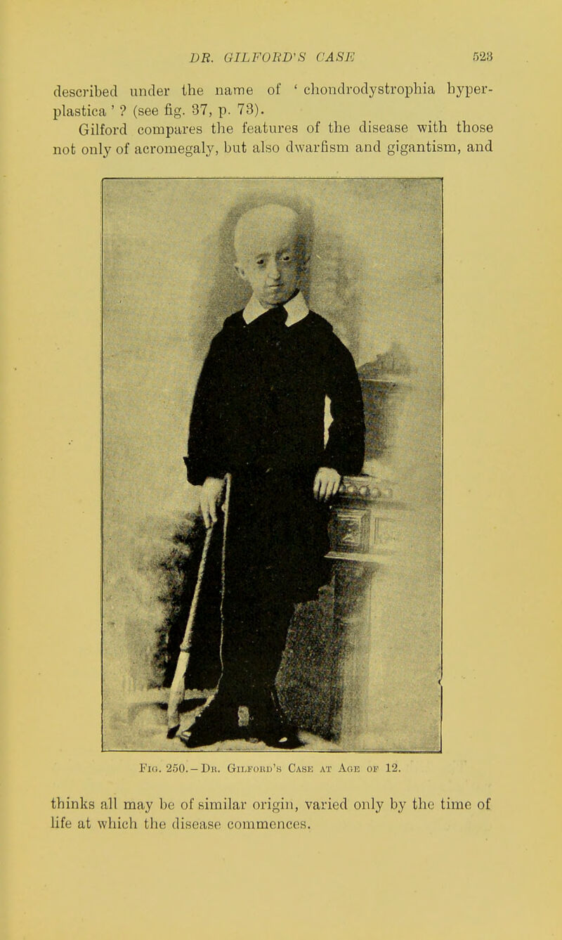DR. GILFOED'S CASE 528 described under the iiatme of ' chondrodystrophia hyper- plastica ' ? (see fig. 37, p. 73). Gilford compares the features of the disease with those not only of acromegaly, but also dwarfism and gigantism, and l-'iG. 250.-Du. GiLFouu's Cask at Age of 12. thinks all may be of similar origin, varied only by the time of life at which the disease commences.