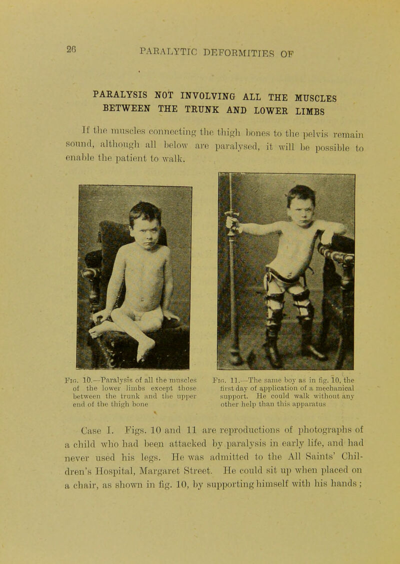 PARALYSIS NOT INVOLVING ALL THE MUSCLES BETWEEN THE TRUNK AND LOWER LIMBS If iho. iiiuscles (>nnnoctinc[ tlie thifj;li liones to tlie pelvis remain sound, ulthouKh fill liolow are paralysed, it will be possible to enalile the patient to walk. Fir,. 10.—Paralysis of all the nniscles Fio. 1].—The same boy a.s in lig. 10, the of the lowei- limbs except those first day of application of a mechanical between the trunk and the upper support. He could walk without any end of the tluKh bone other help than this apparatus Case I. Figs. 10 and 11 are reproductions of photographs of a child who had been attacked by paralysis in early life, and had never used his legs. He was admitted to the All Saints' Chil- dren's Hospital, Margaret Street. He could sit up when placed on a chair, as shown in fig. 10, by supporting himself with his hands ;